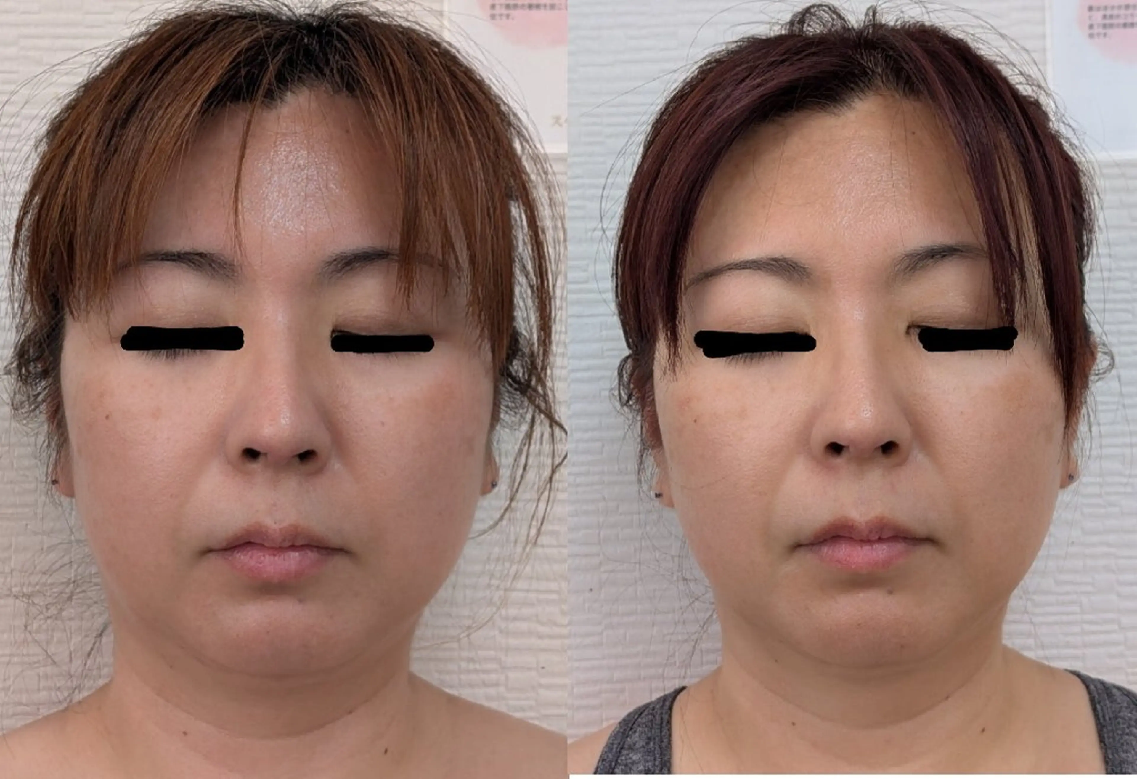 エステ レチノール/ニキビ/ 毛穴ケア　浅川のエステ・リラクイメージ