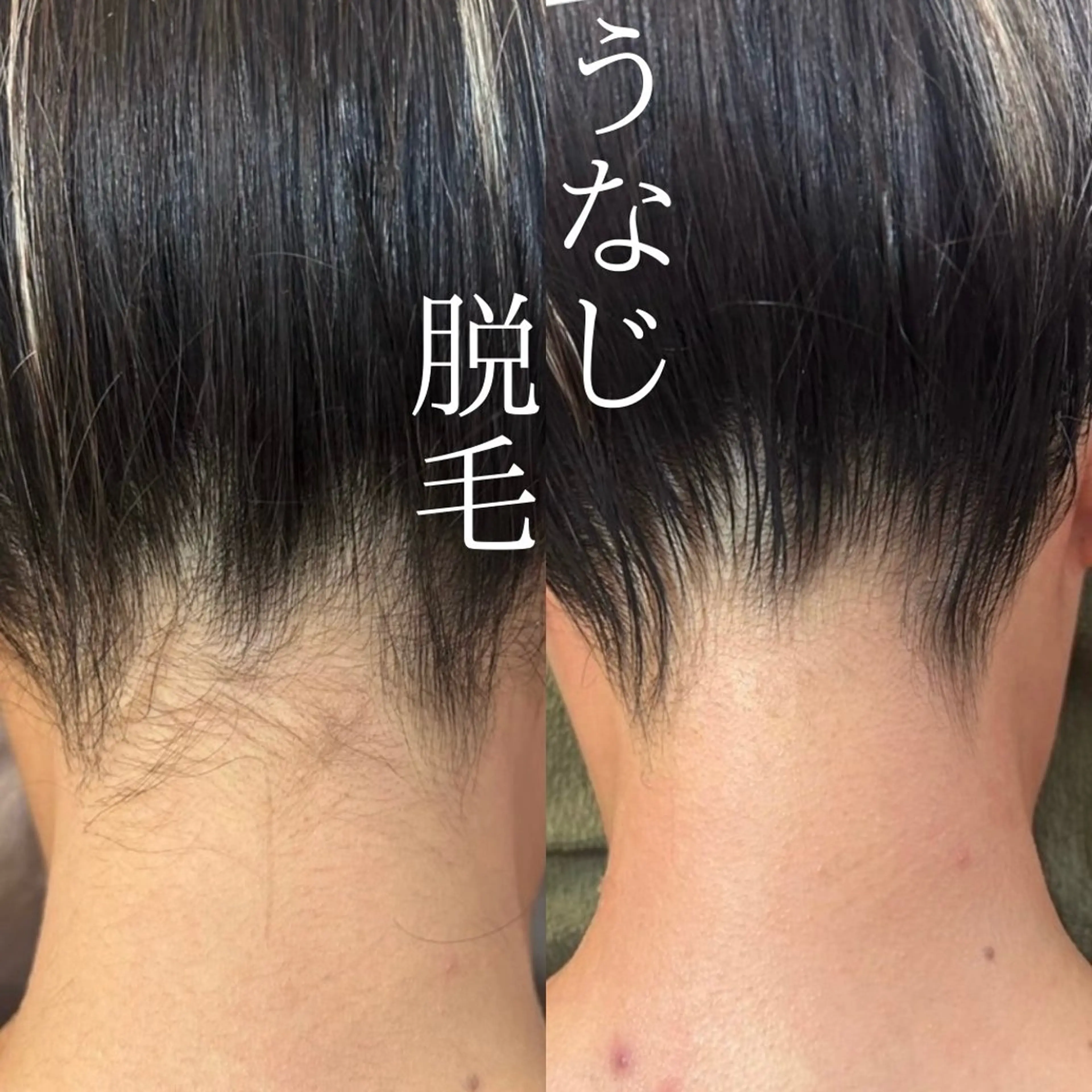 【成人式特別メニュー✨】うなじ＋背中上脱毛【学割U24】の写真