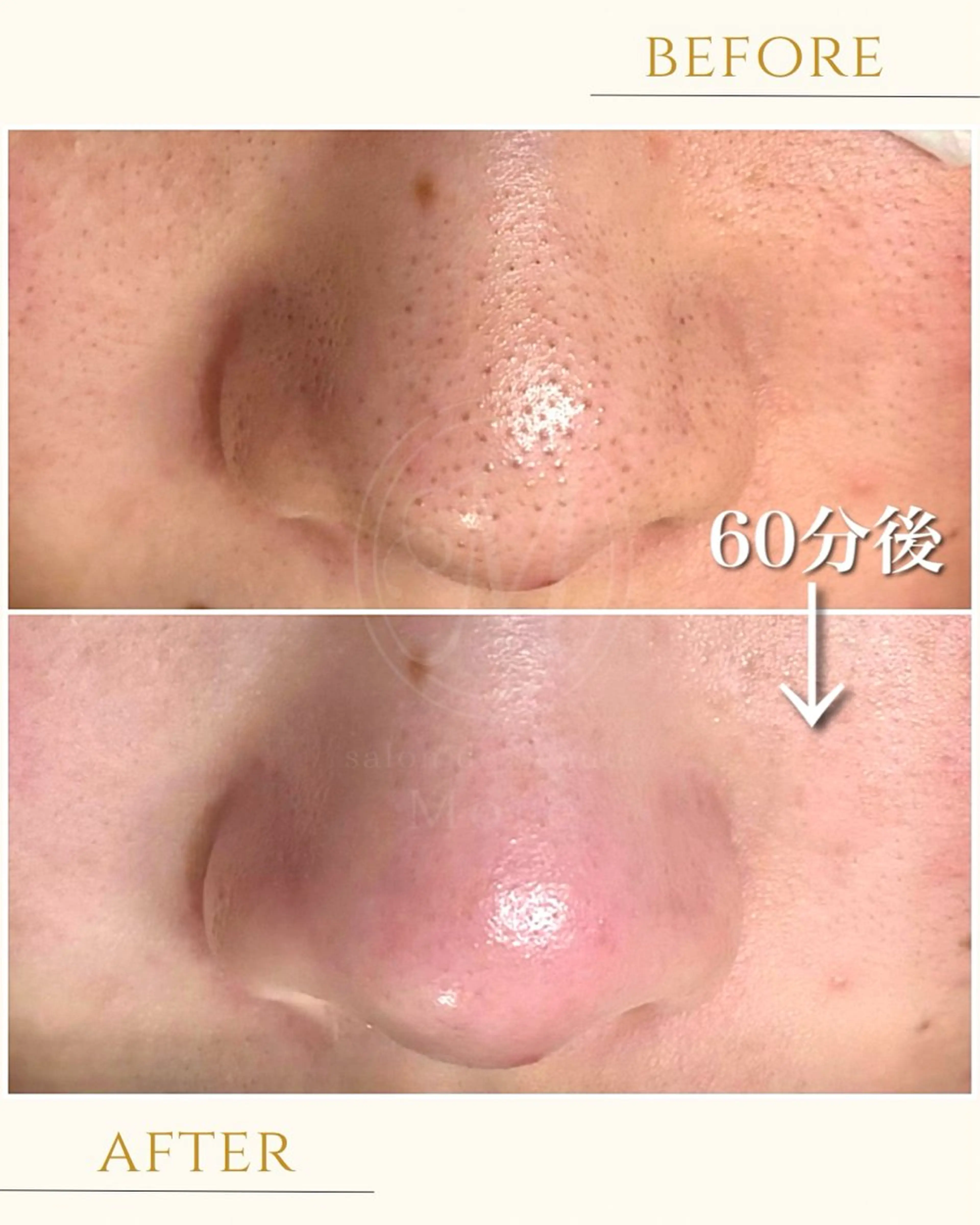 (ご新規様)毛穴ケアコース80分 最新毛穴技術により頑固な黒ずみやザラつきを根こそぎ除去。ヘッド・デコルテマッサージ付きの写真