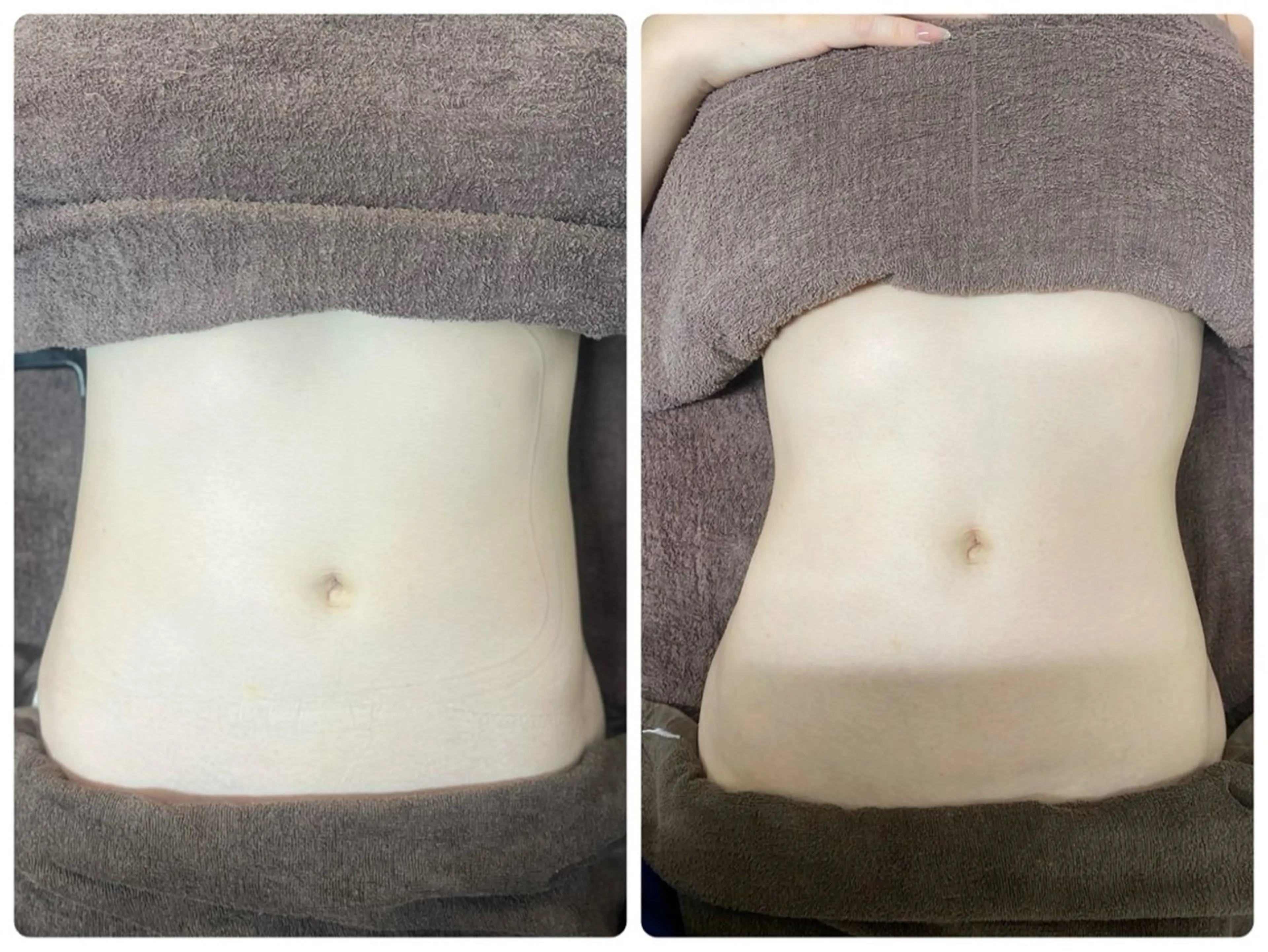 【つるんボディ＆即くびれ】インディバ＆カーボキシー炭酸ガスパックの写真