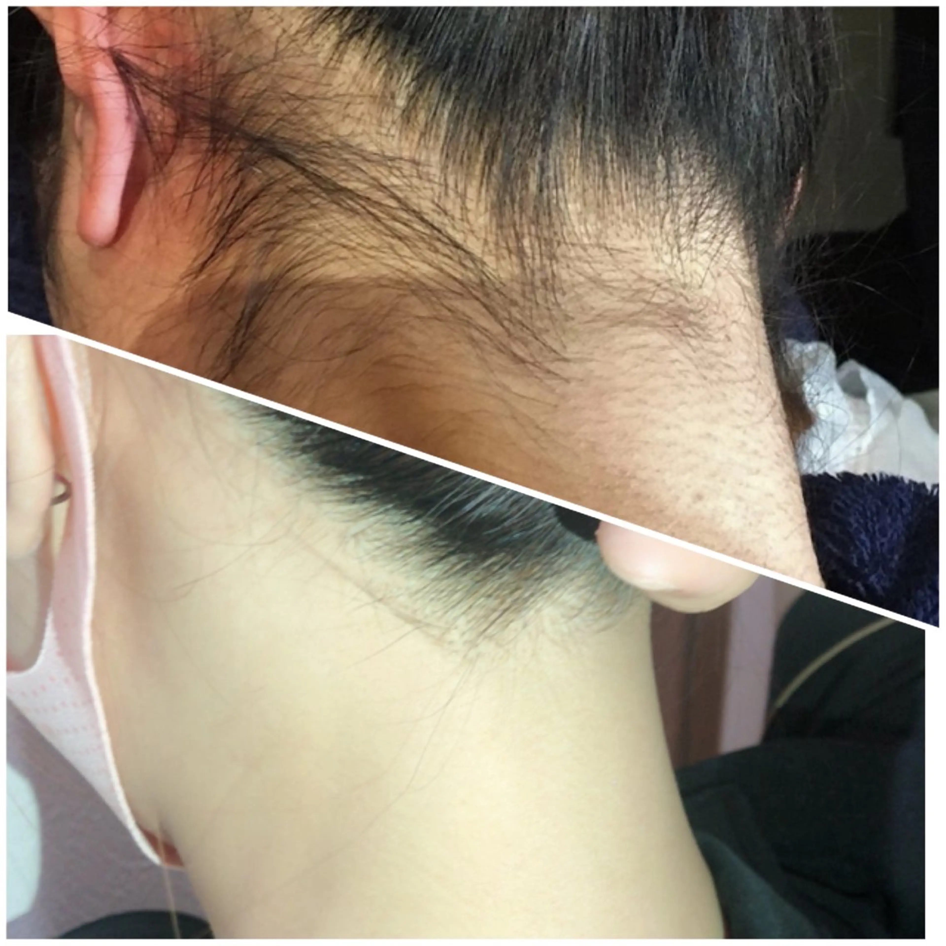 レディース 【うなじ脱毛】 うなじスッキリで首長く、小顔効果✨️！の写真