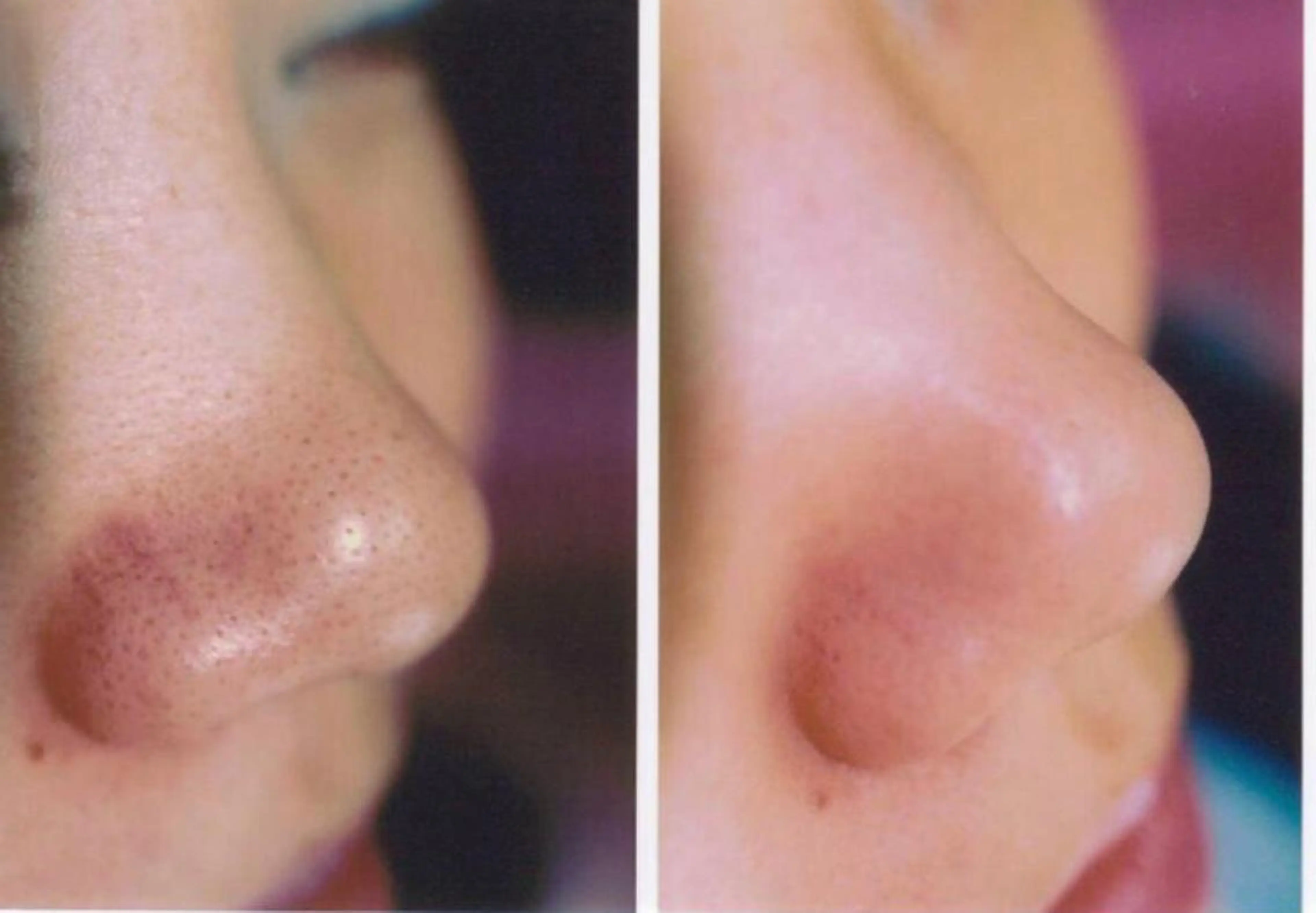 【ミニモ限定】鼻の毛穴つるつるすべすべコースの写真