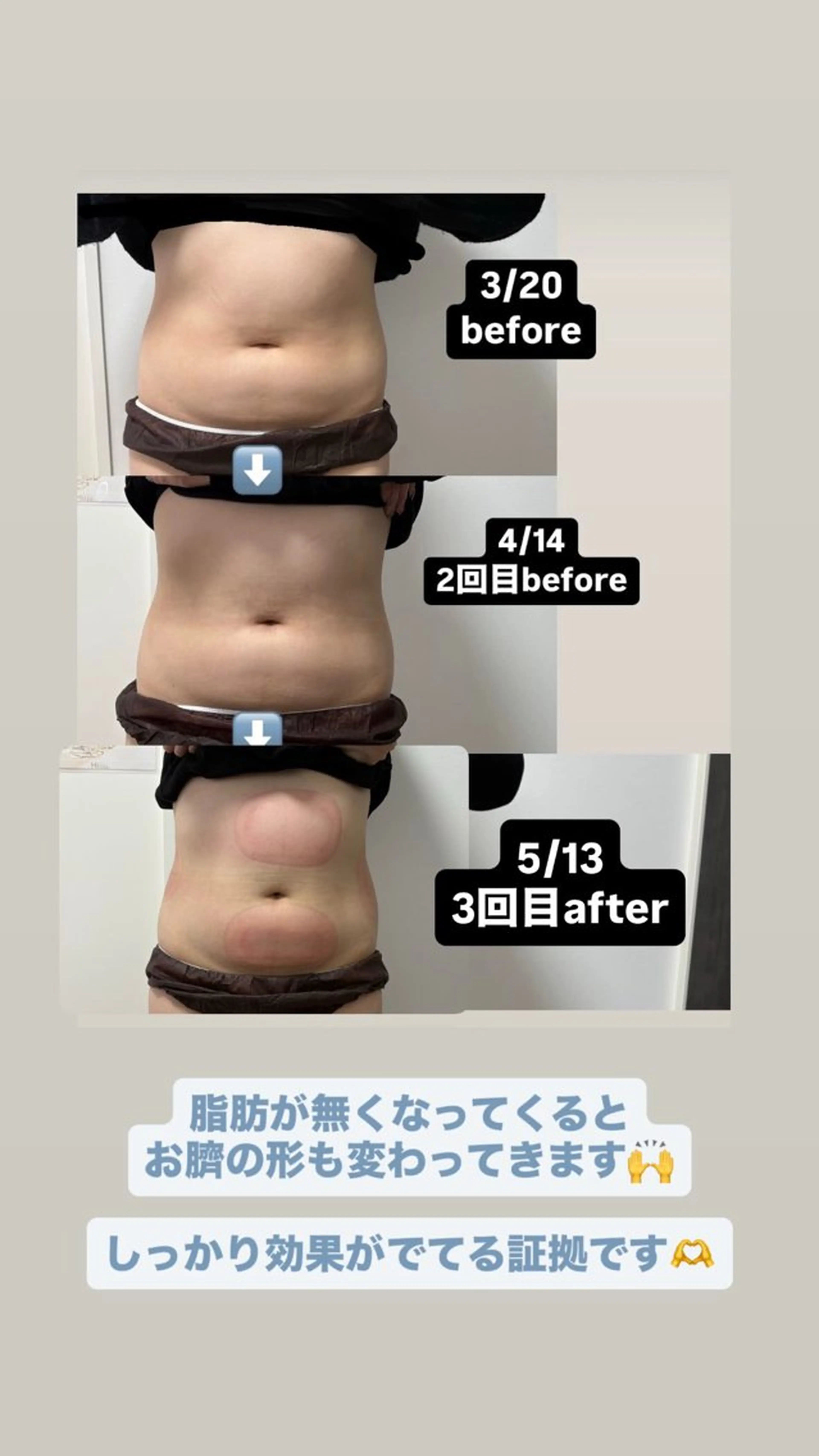 エステ Miiju.所属・Miiju. 石巻市 脂肪冷却  鈴木のエステ・リラクイメージ