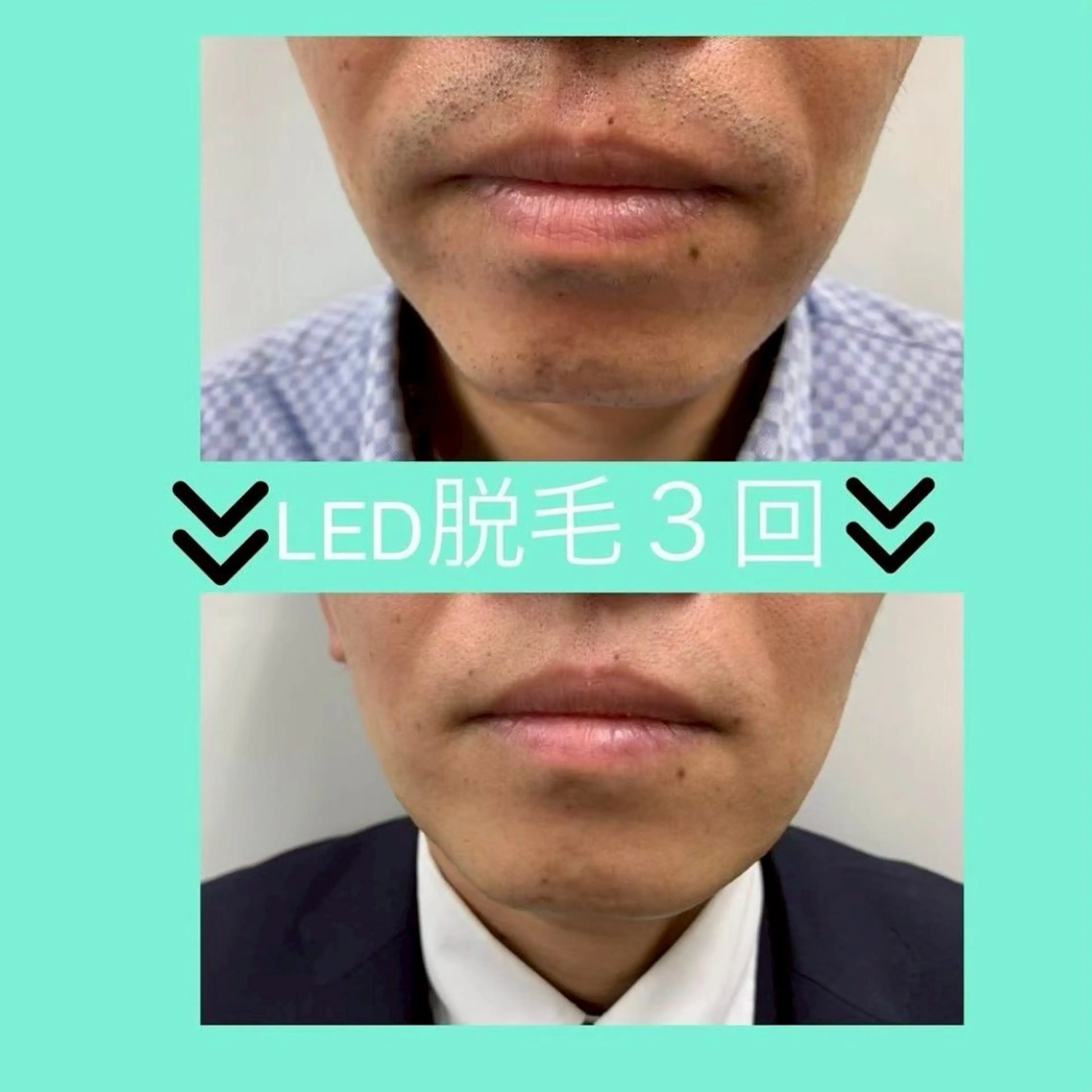 【男性限定】ヒゲ脱毛の写真