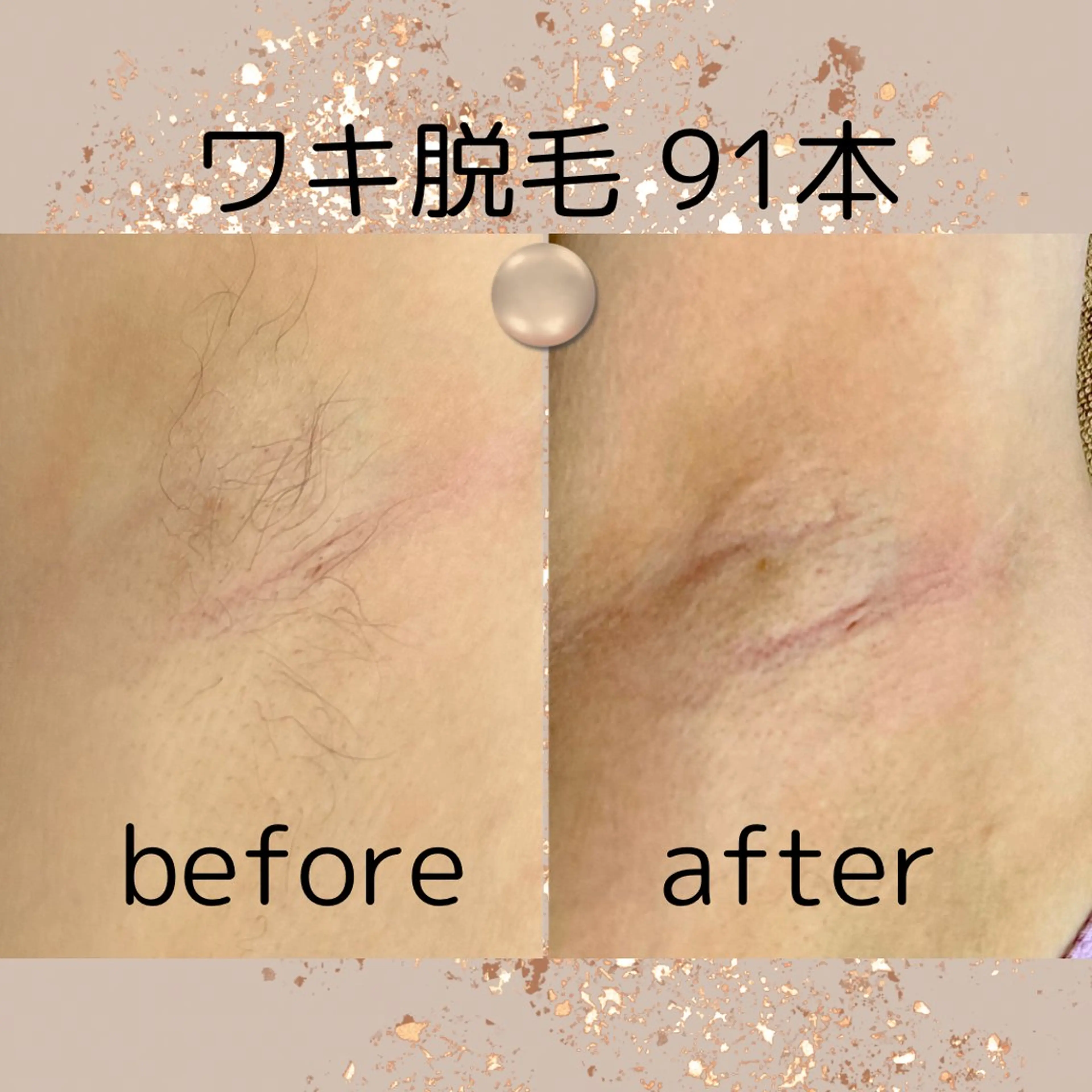 美容電気脱毛❦お試し！【ワキ】ライトで効果を感じない方へ♡おすすめ！❤限定料金❤カウンセリング込(女性限定！！)100本の写真