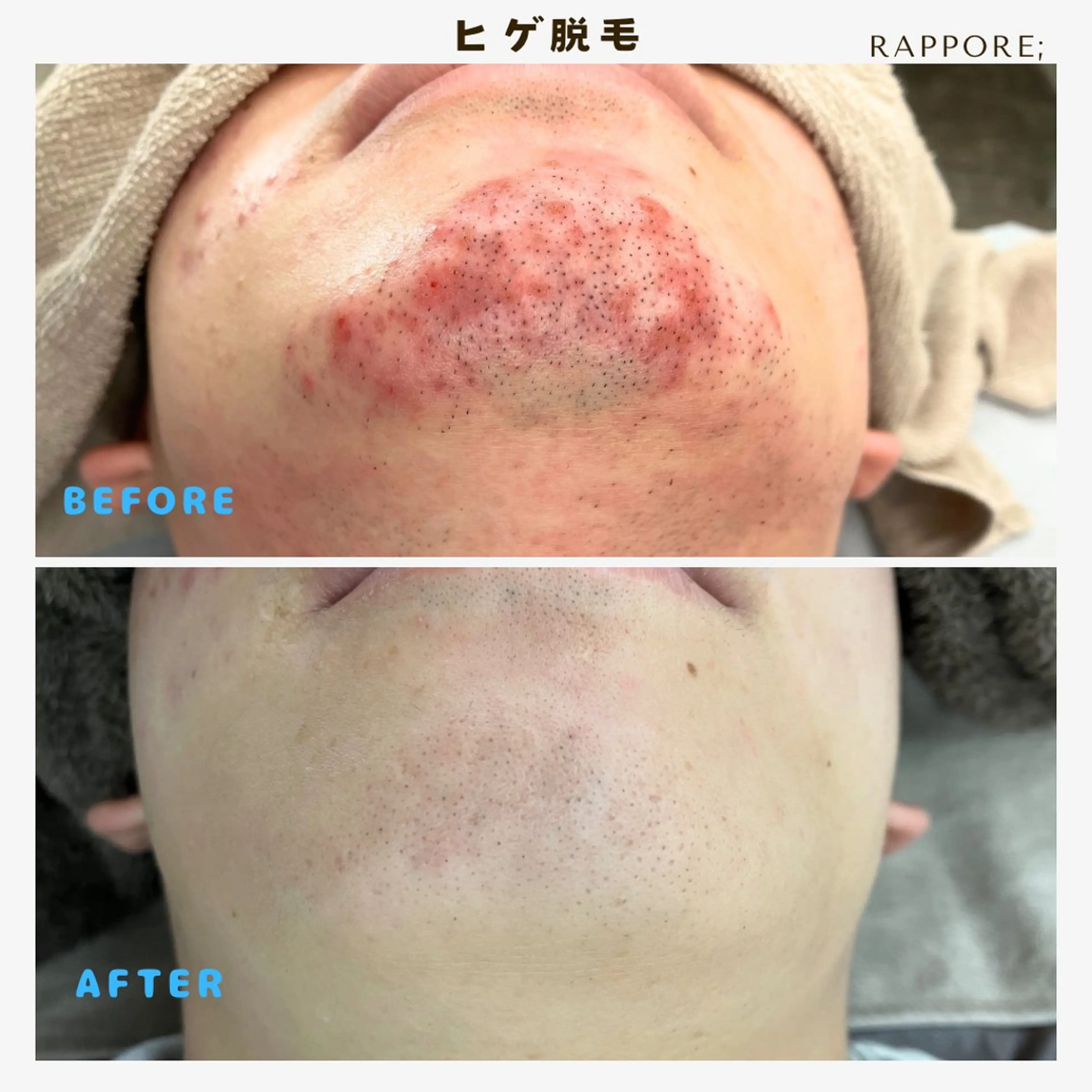 メンズ 脱毛 Rappore; 心斎橋　みずきのエステ・リラクイメージ