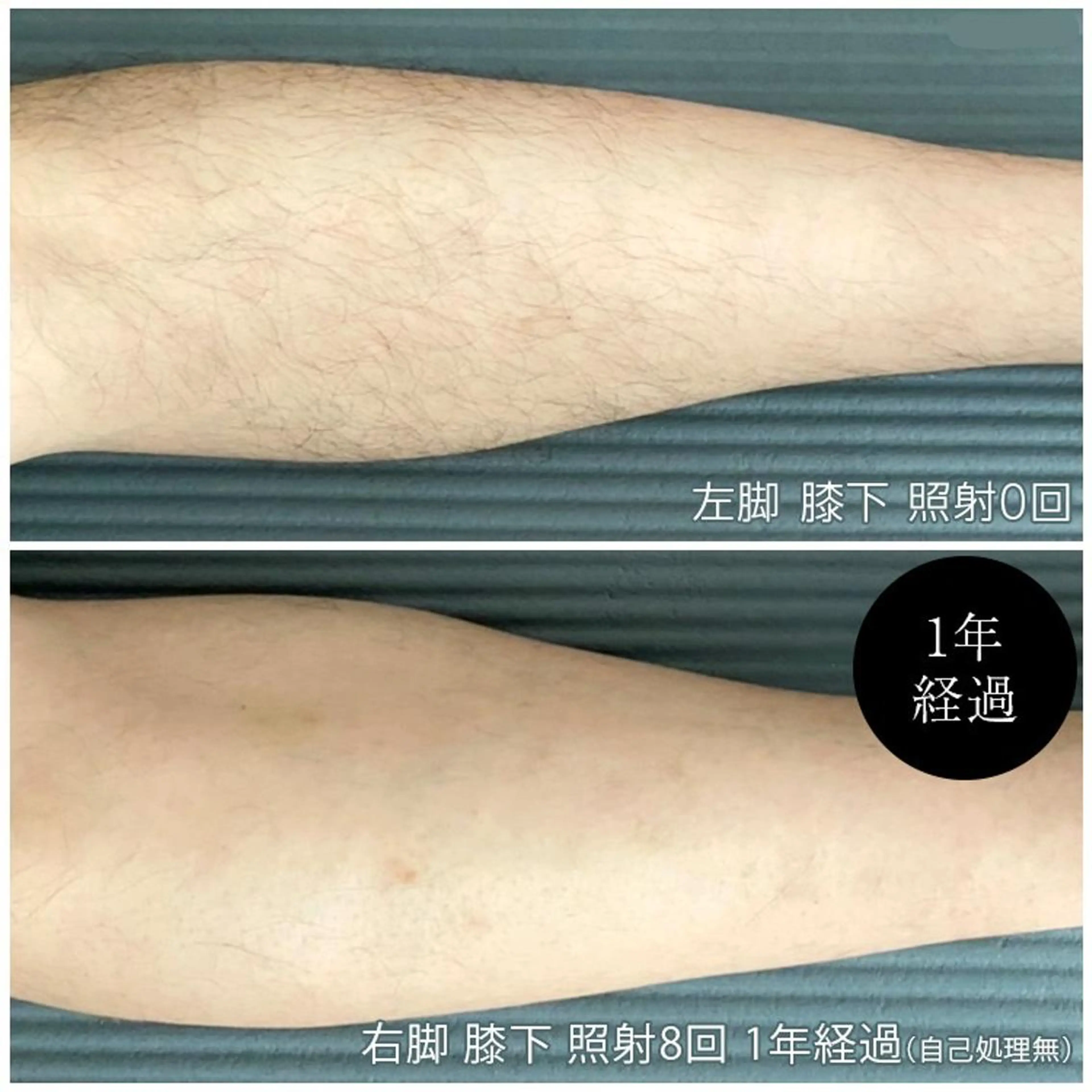 【男性】太もも、膝、スネ脱毛初回半額クーポンの写真