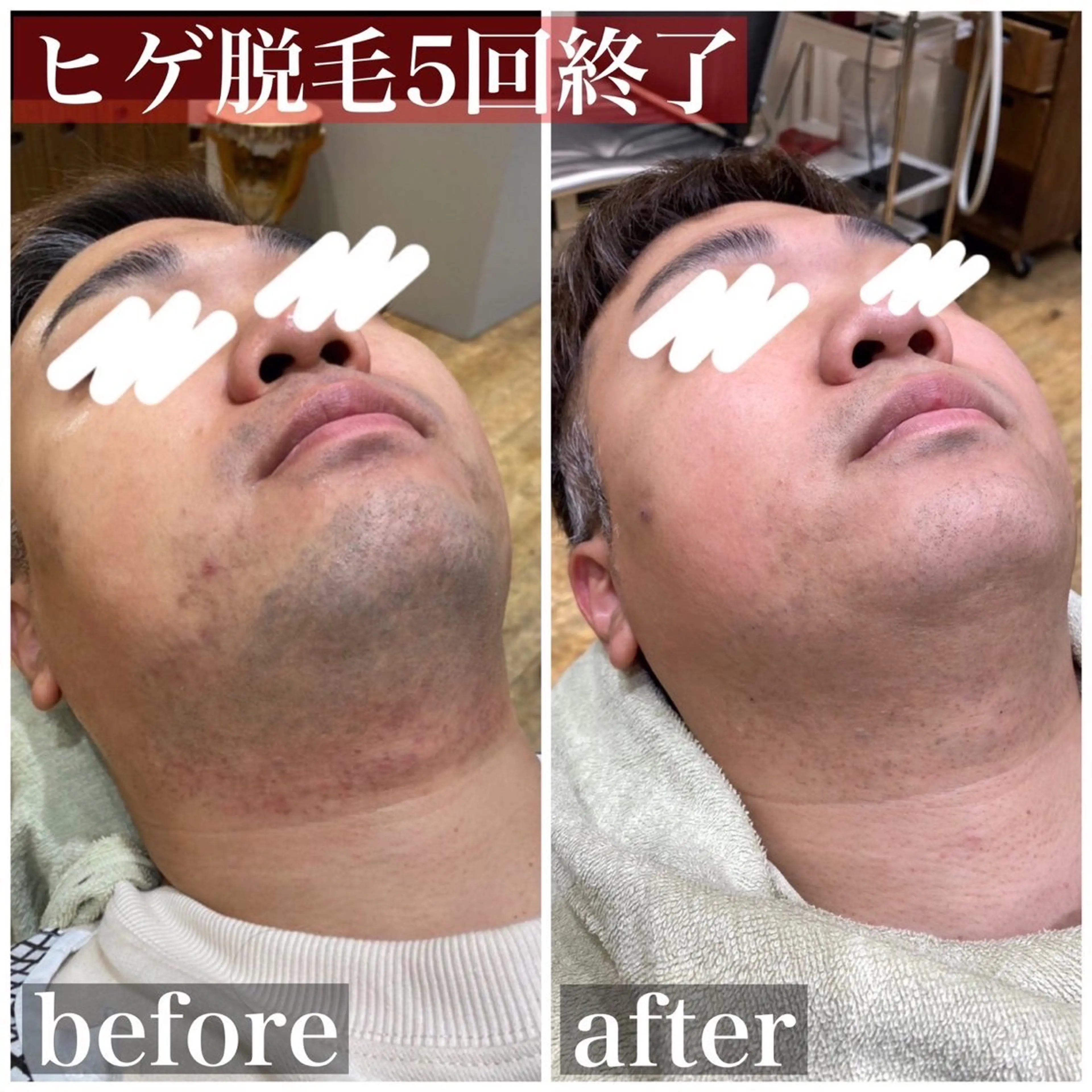 メンズ 脱毛 HAIRS YOSHIOKA所属・ヘアーズヨシオカ MENSヒゲ脱毛のエステ・リラクイメージ