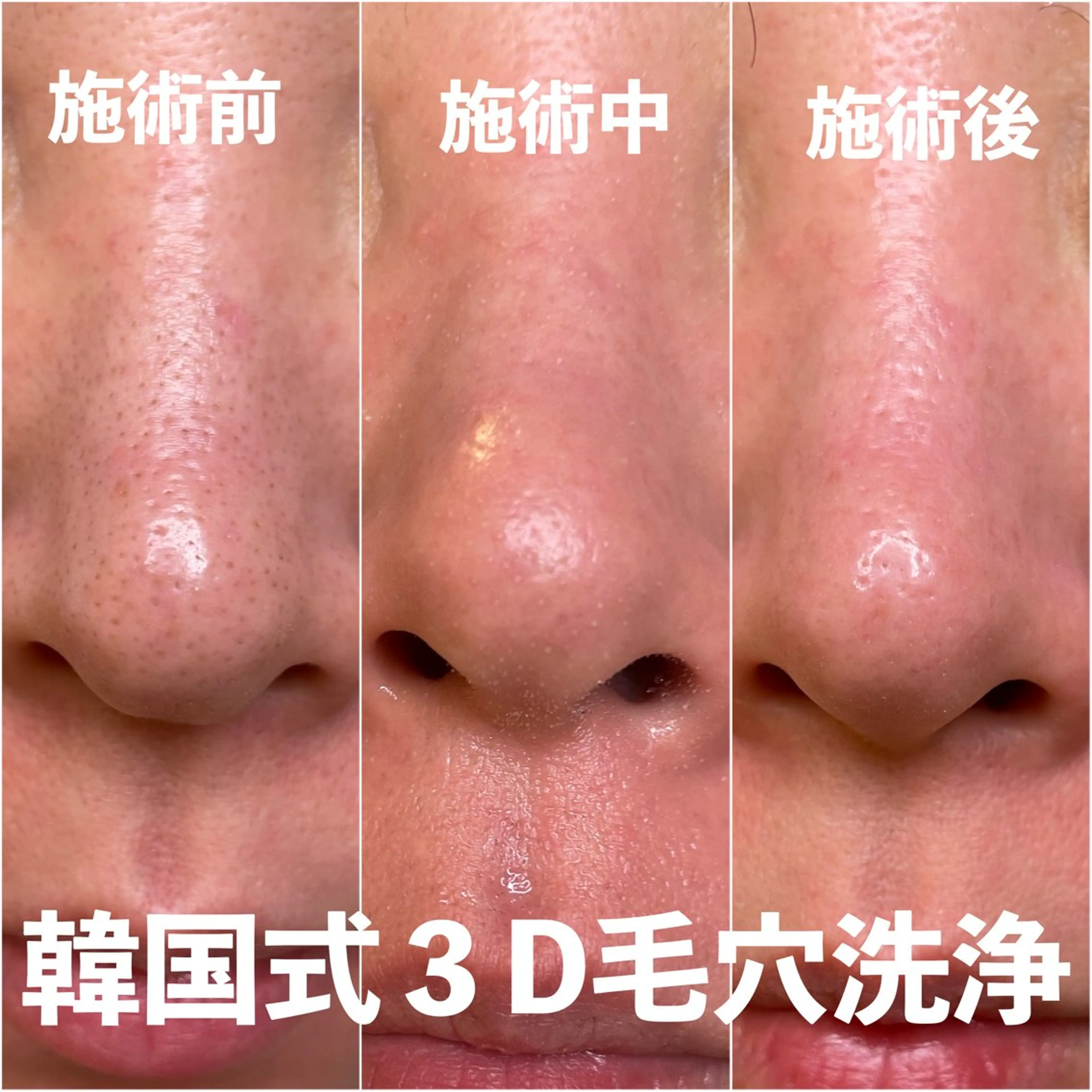 【圧倒的結果の出る毛穴洗浄】韓国式3D毛穴洗浄モニター募集の写真