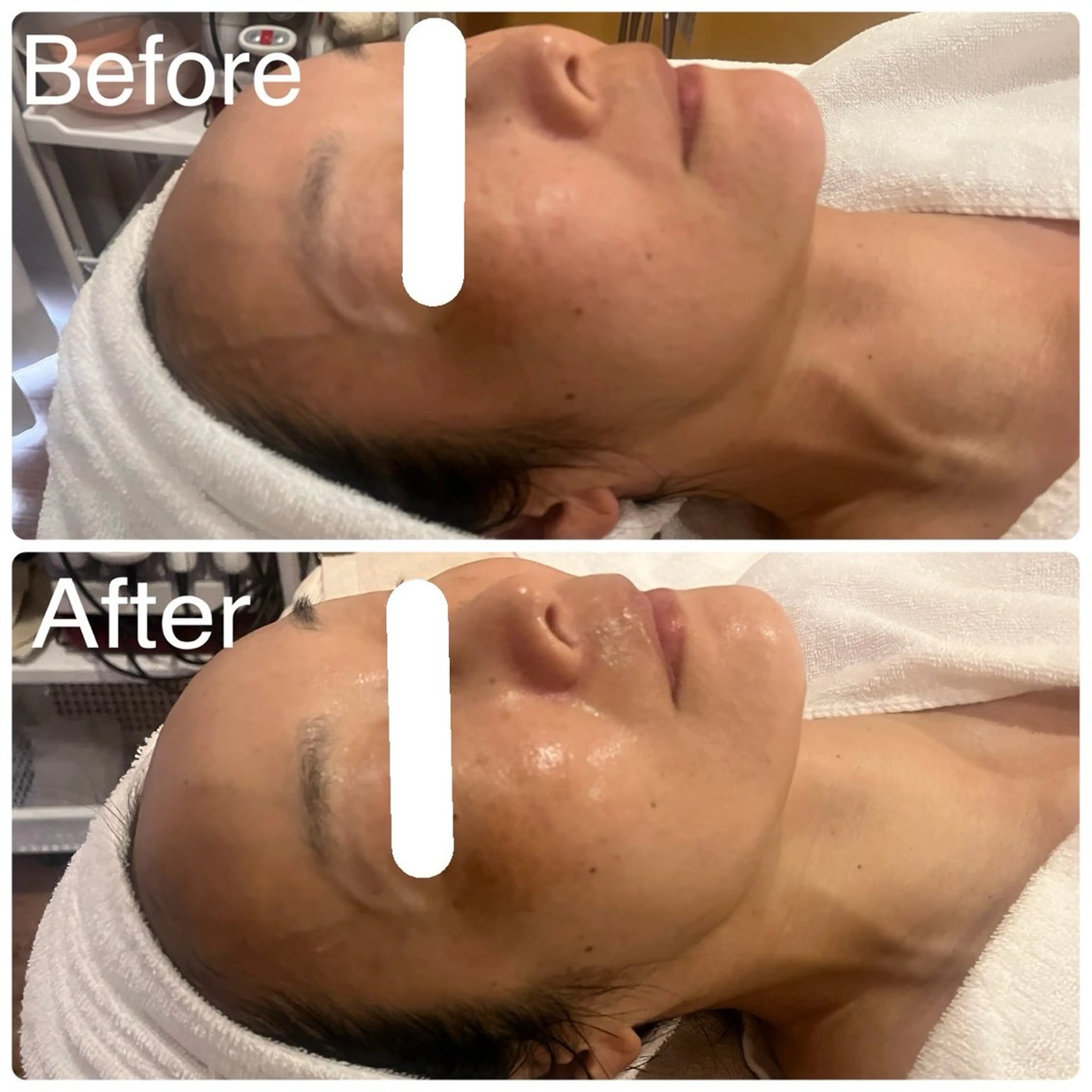 エステ リラク miel所属・毛穴＆ホワイトニング mielのエステ・リラクイメージ