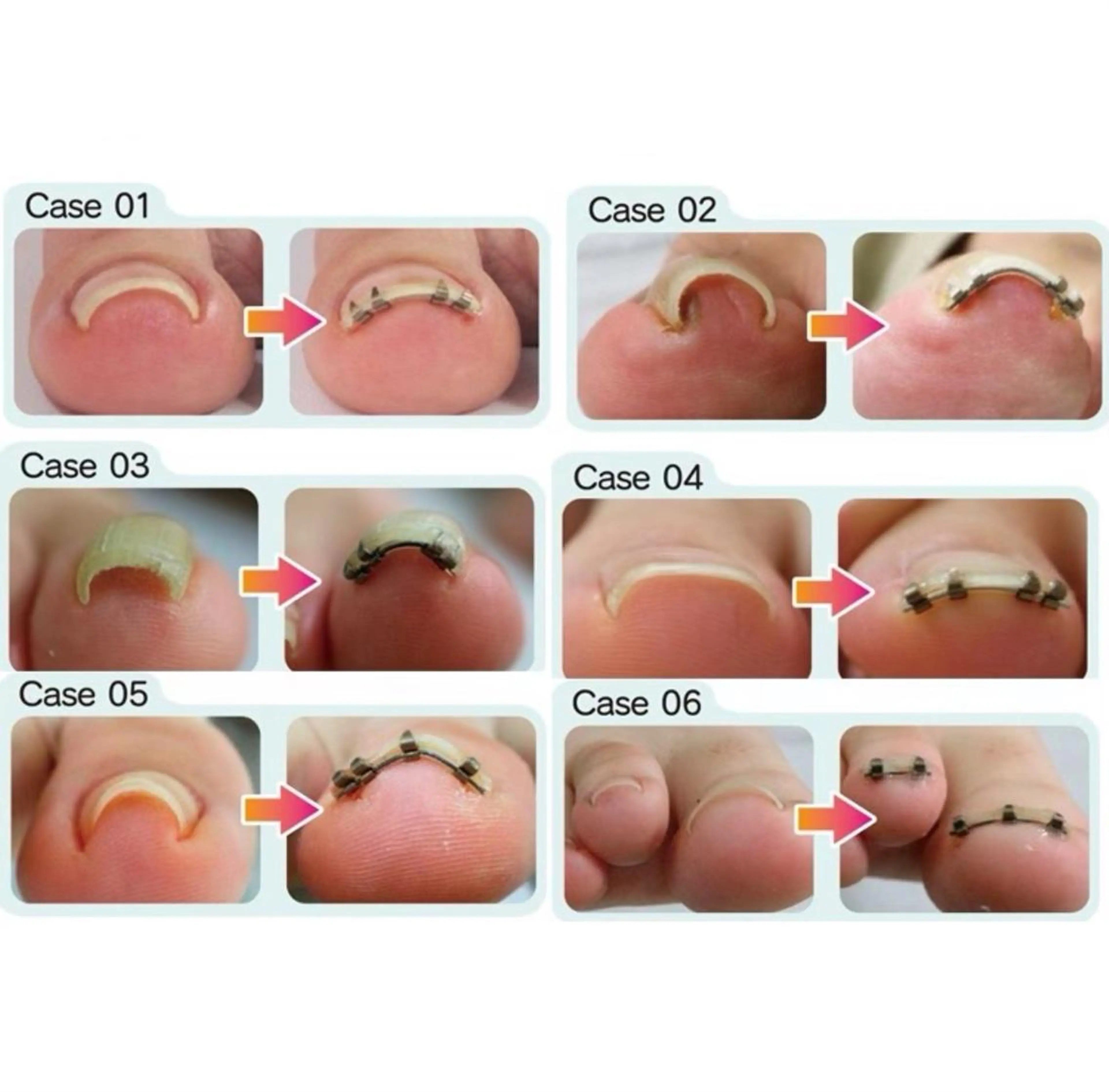 巻き爪矯正(1本)👣モニター募集🌈¥5000✨2本の方はメッセージにてお知らせ下さい❗️の写真