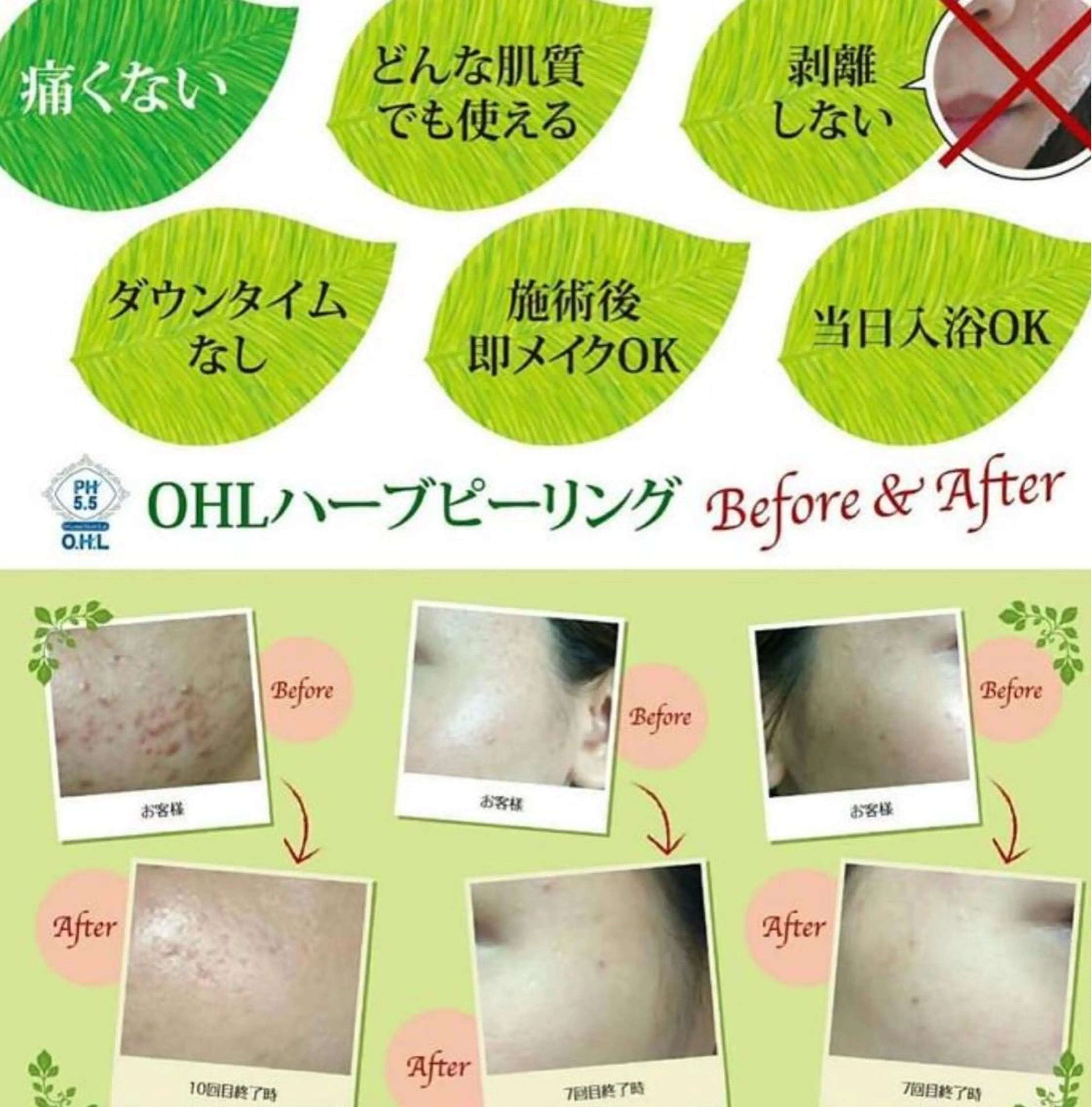 【学割U24】【肌質改善】洗顔+毛穴洗浄+OHLハーブピーリング+パック+LED付き 60分の写真