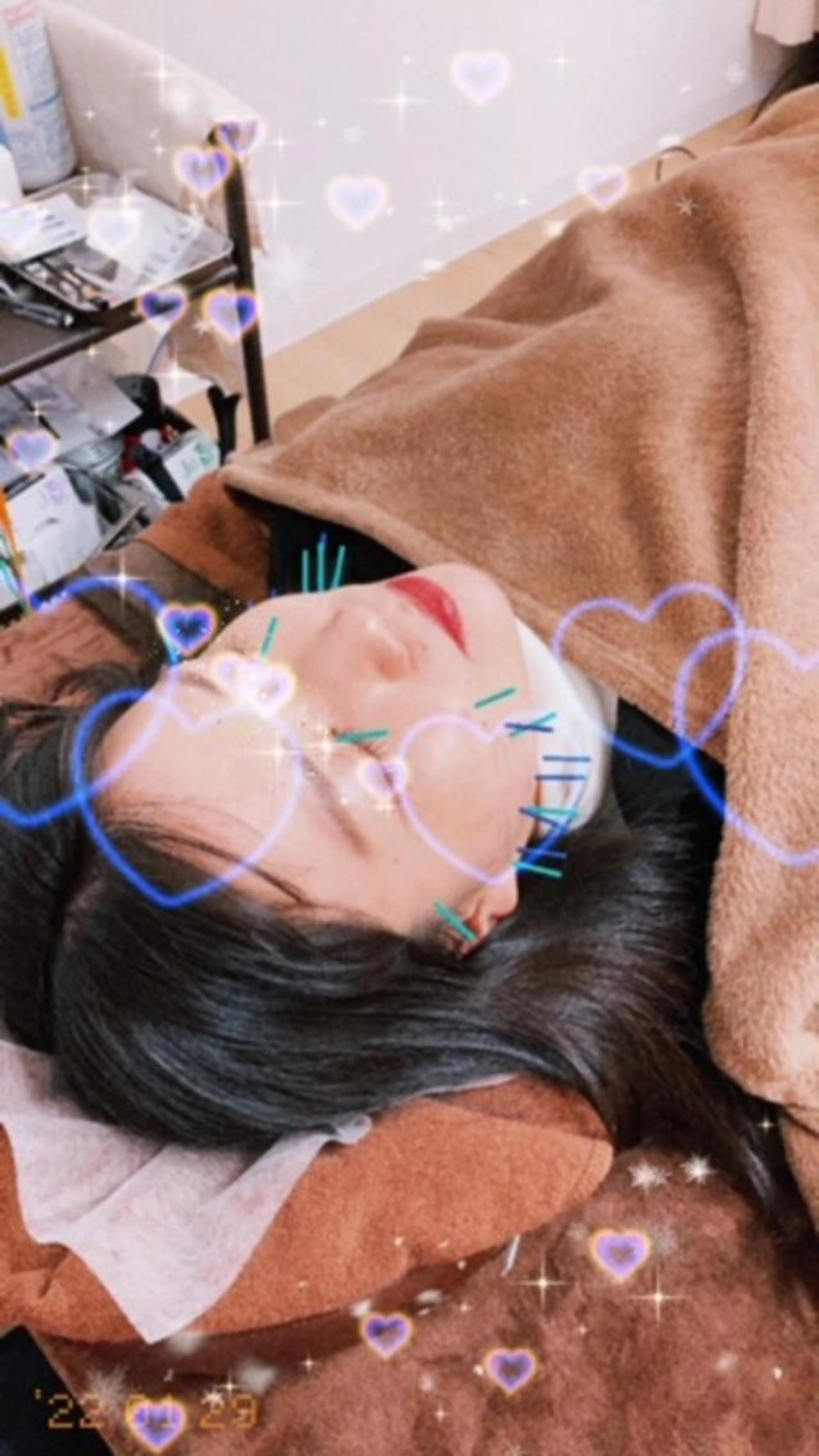 🌸【12、1月限定価格】【火、木、土曜限定】【女性限定】美容鍼　　美容鍼初めての方おススメ💕の写真