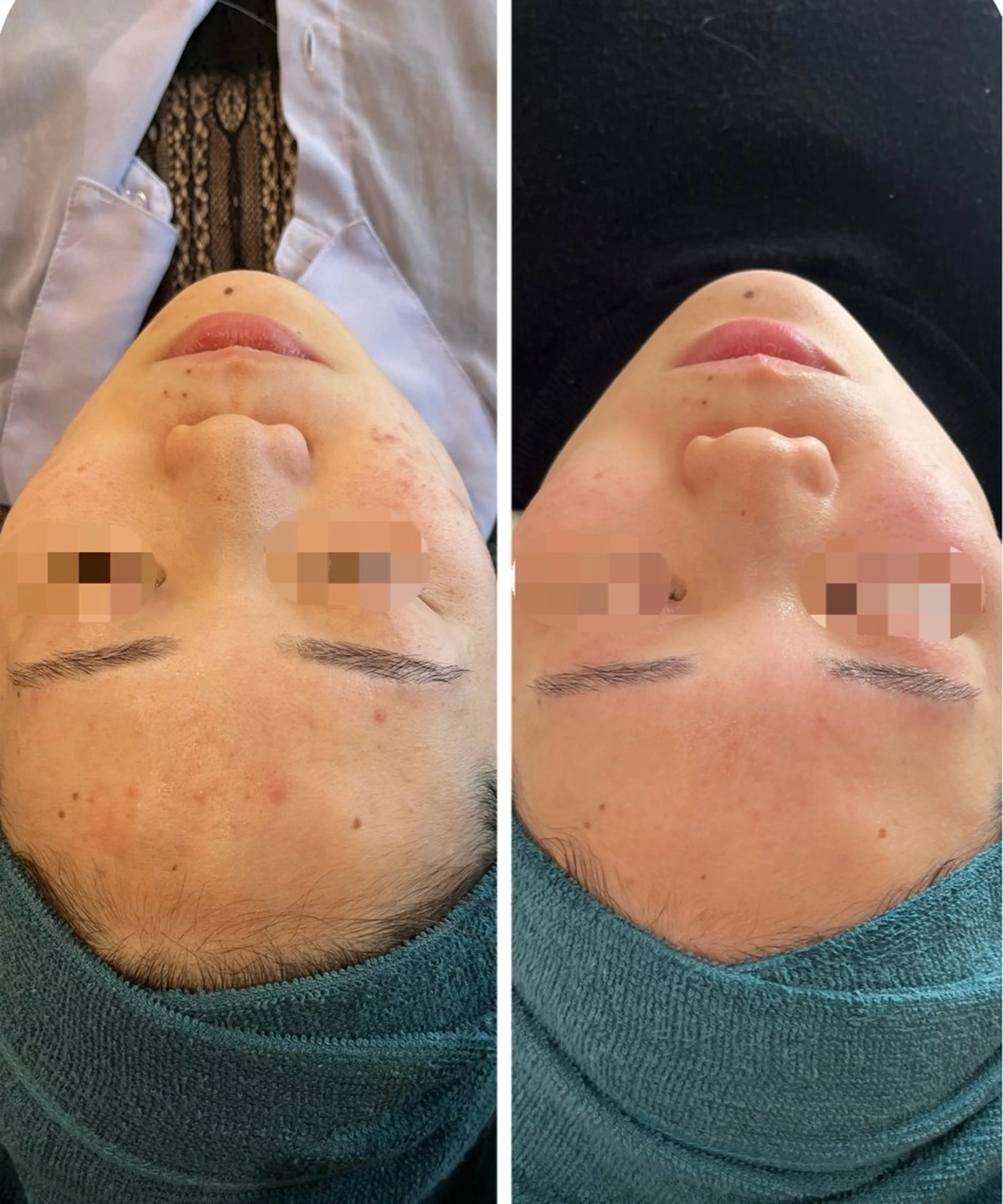 エステ 【リベルハーブピーリング認定店】敏感肌・美白脱毛専門店Dione立川店所属・Dione 立川店のエステ・リラクイメージ