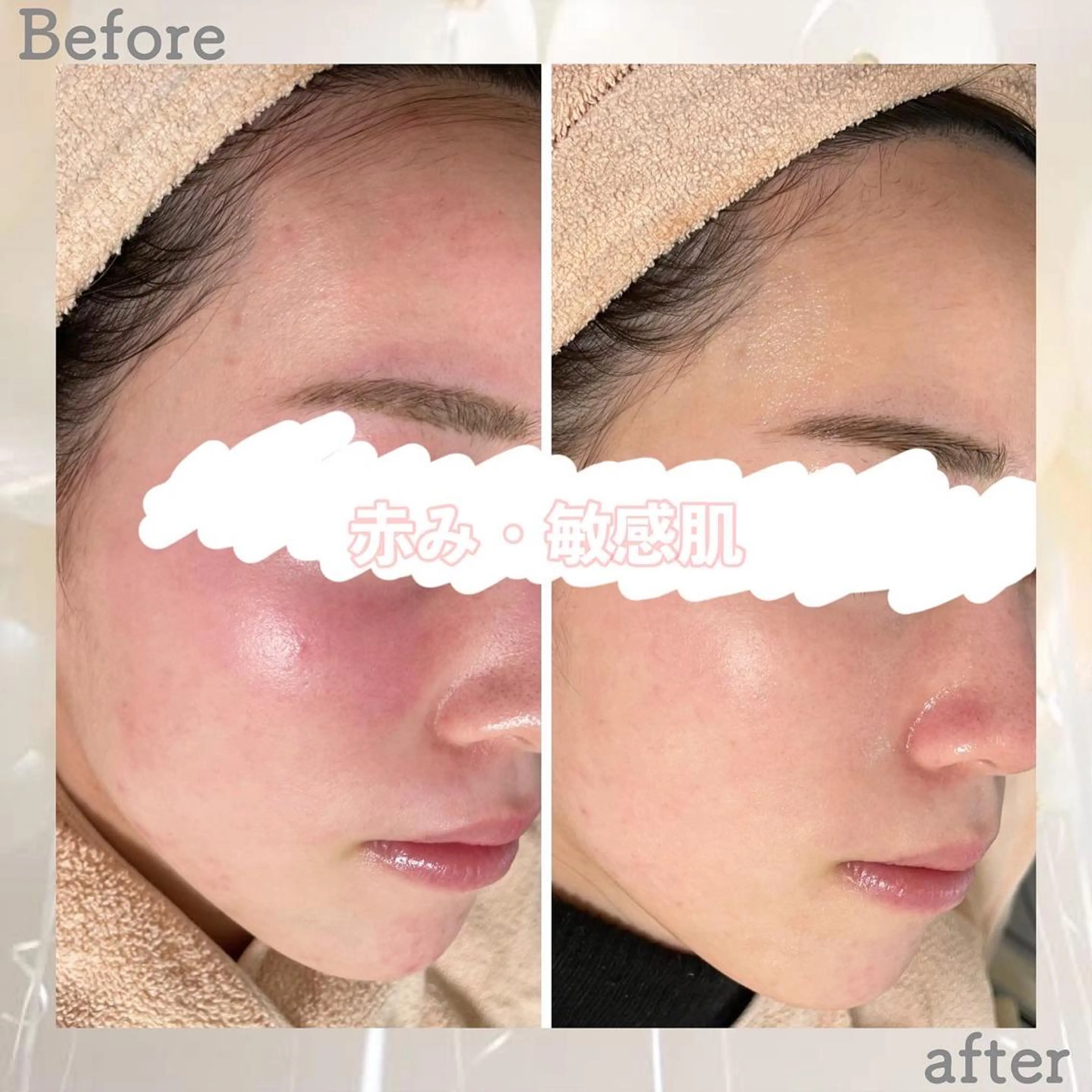 エステ ニキビ&跡改善サロン オーナー光木のエステ・リラクイメージ