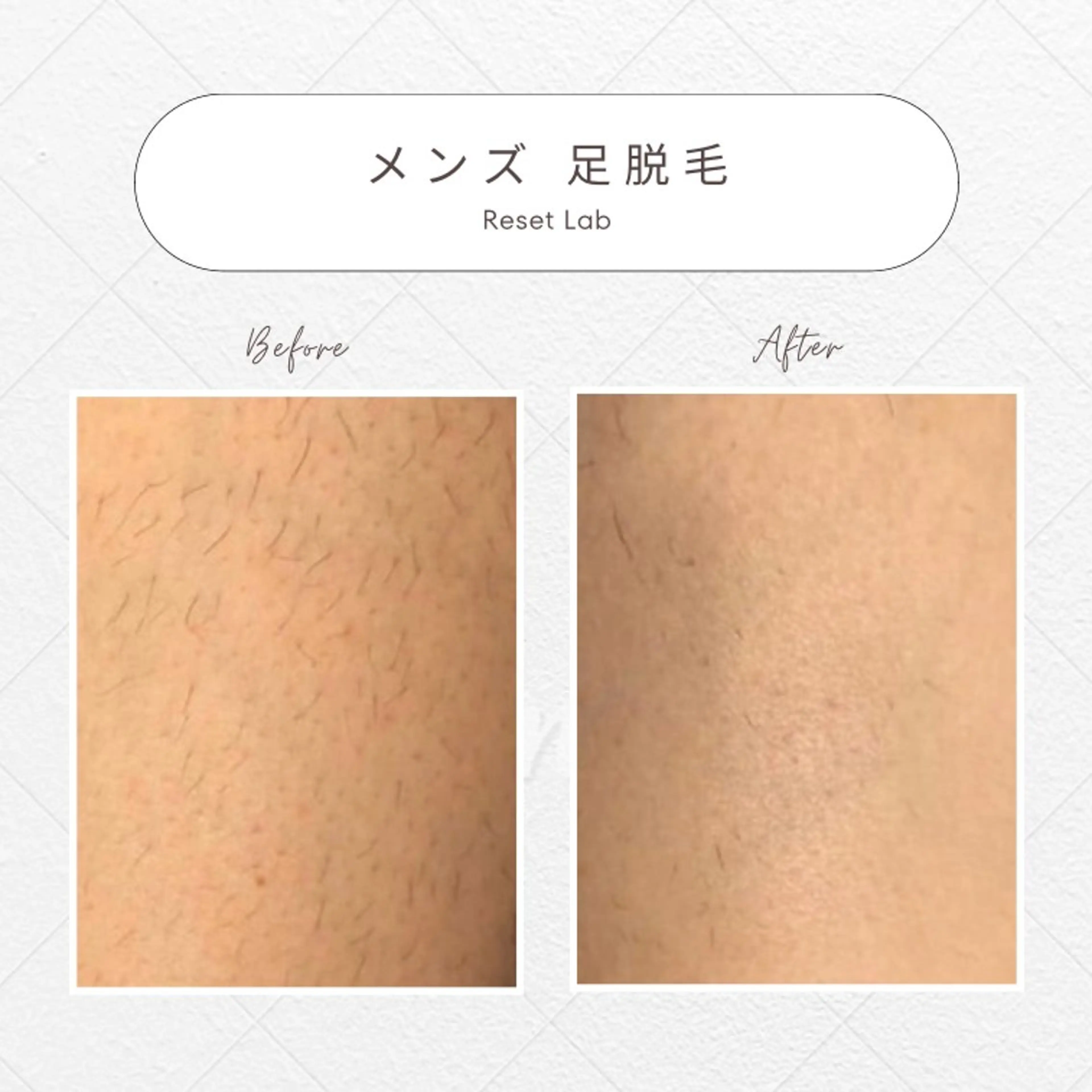 🌿メンズ足脱毛の写真