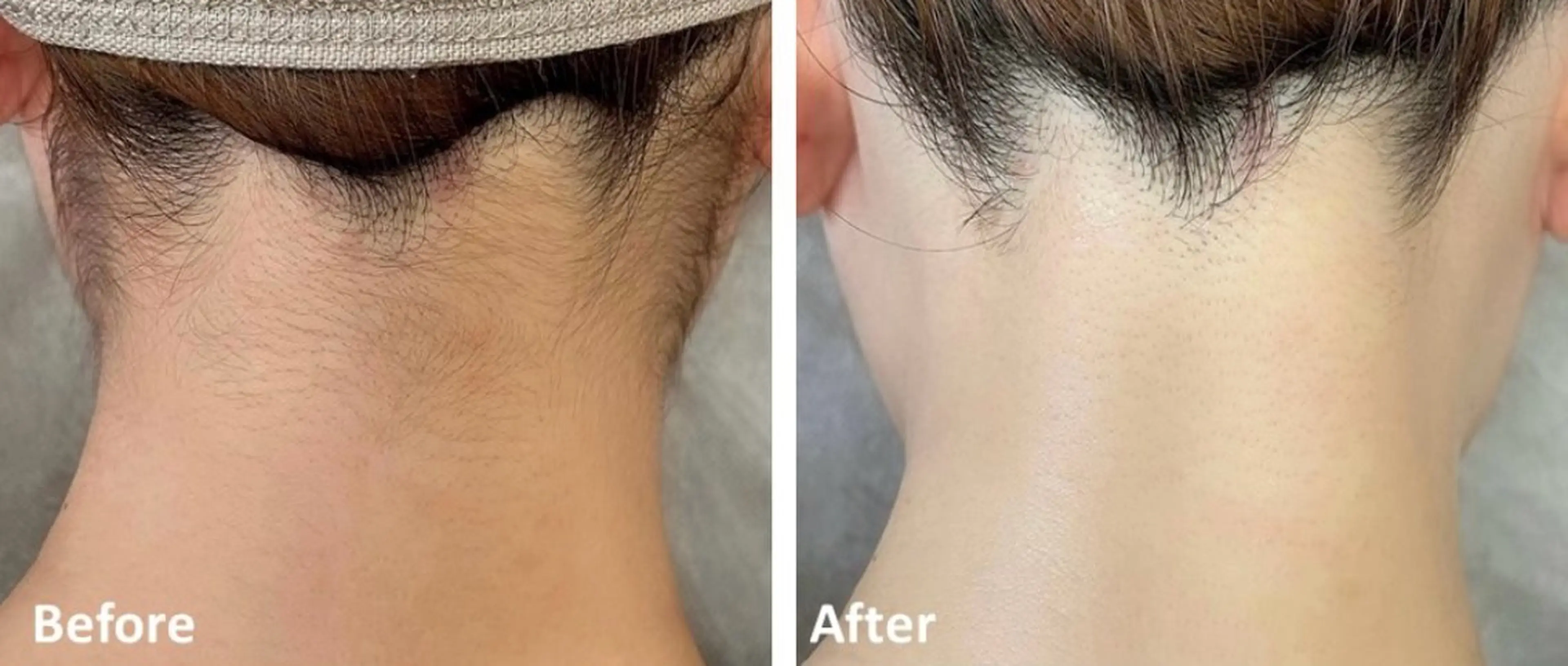 【うなじ脱毛】✨後ろ姿プロデュース✨ショートやアップヘアでも自信がもてる✨大人気メニュー！！の写真