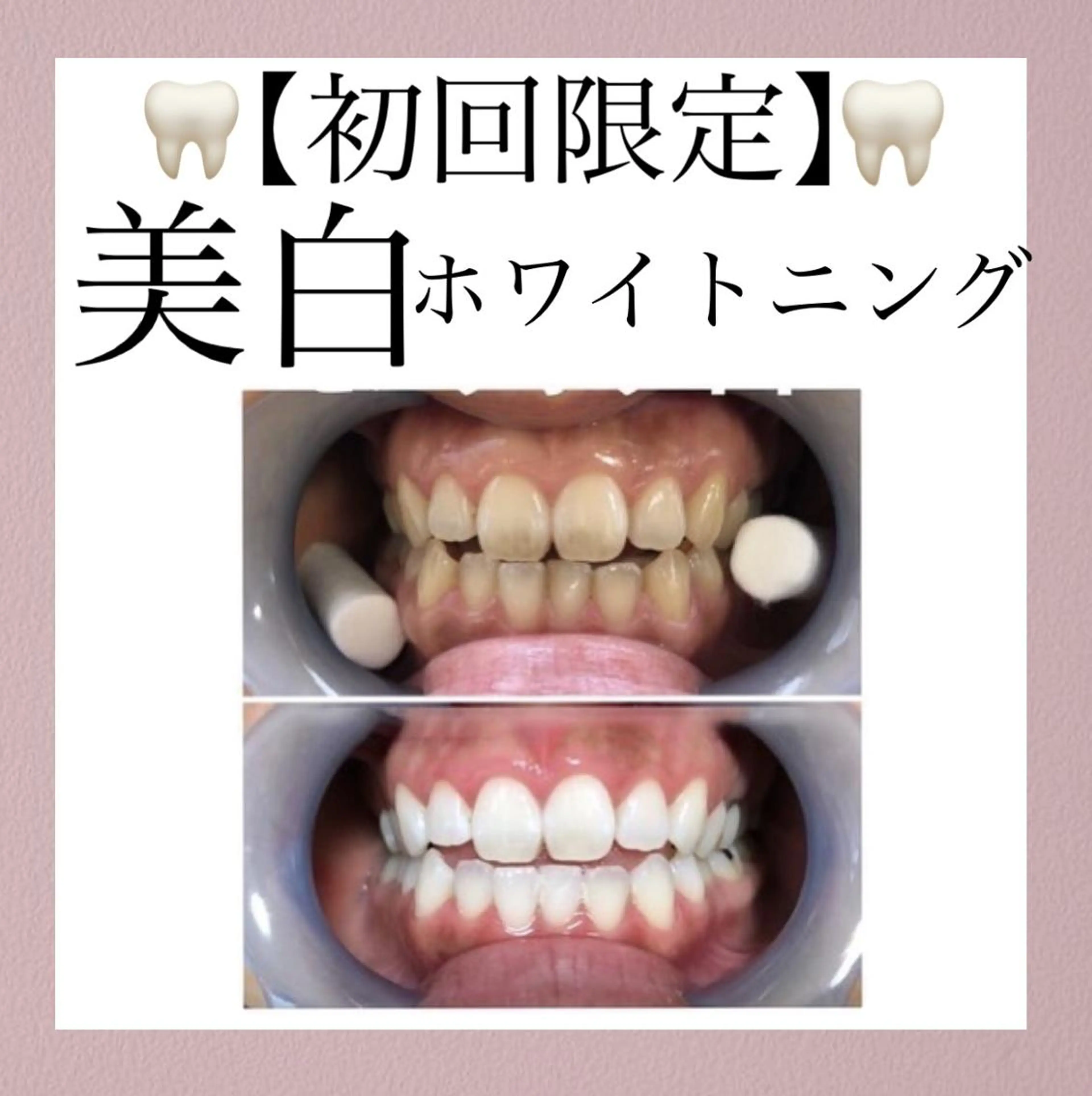 【美歯セルフホワイトニング】3回(15分)セットが4,980円の写真