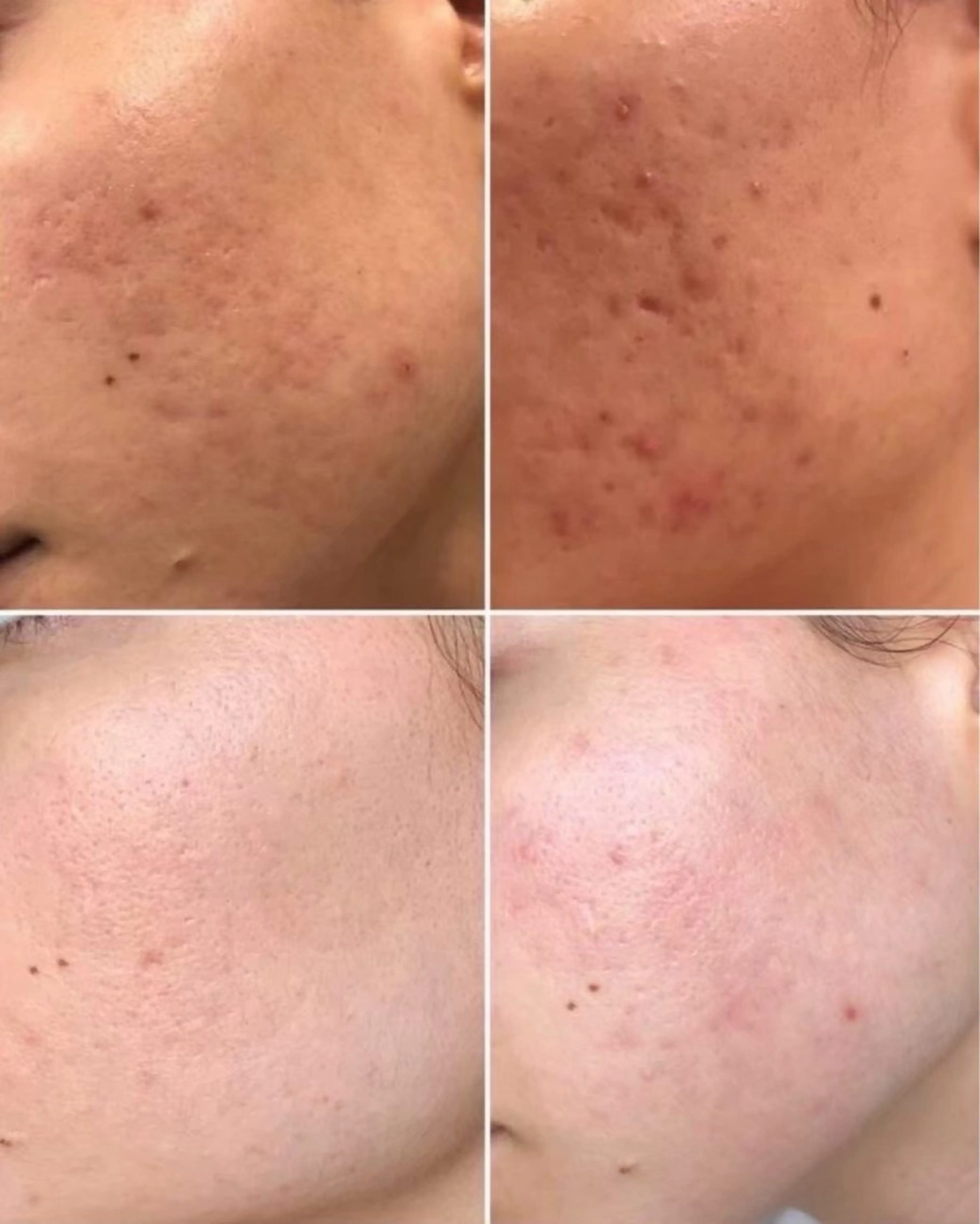 光フェイシャル60分コースの写真