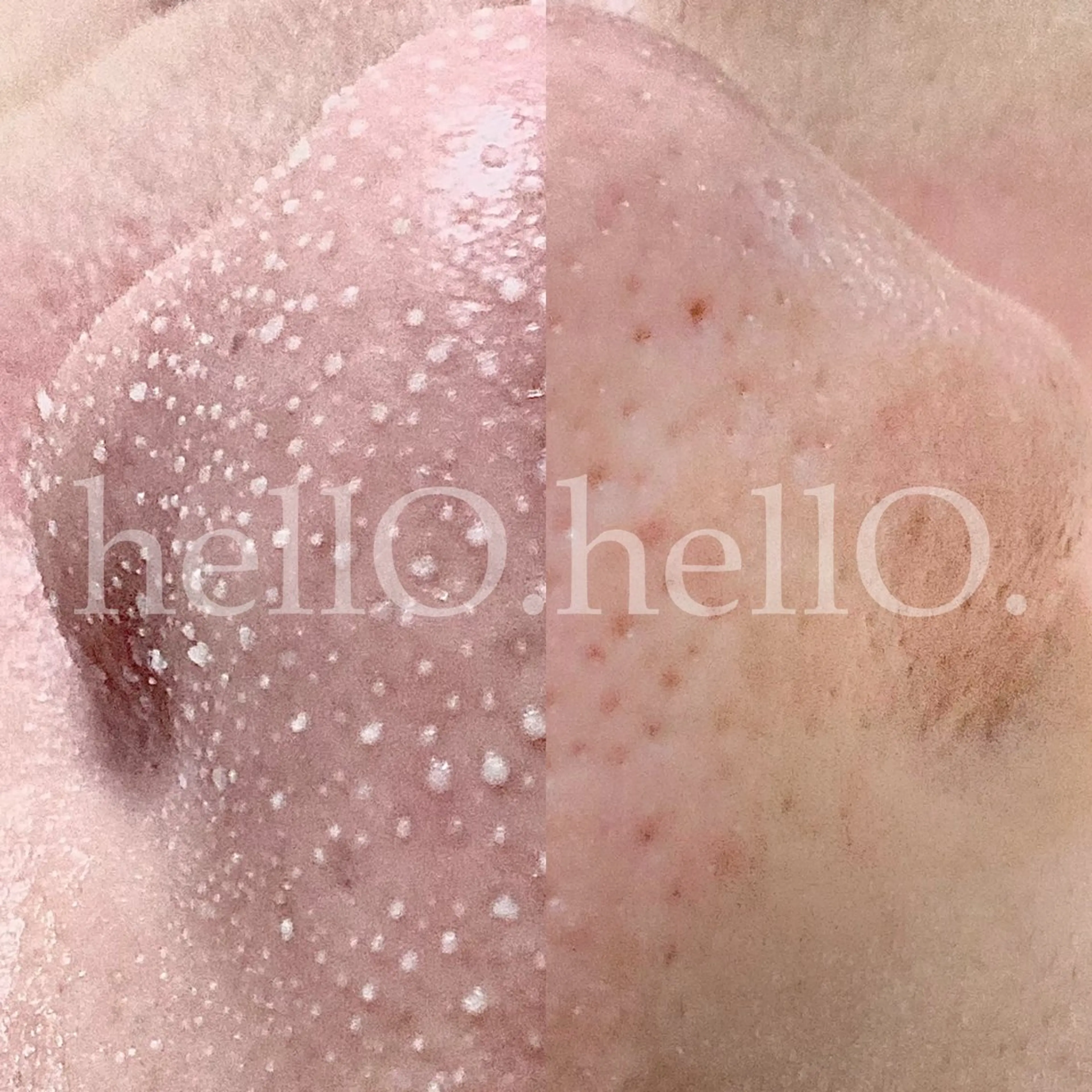 韓国式3D毛穴洗浄　毛穴の詰まりが、比較的ある方を募集しております。　黒ずみがなかなか取れない方大歓迎です。の写真