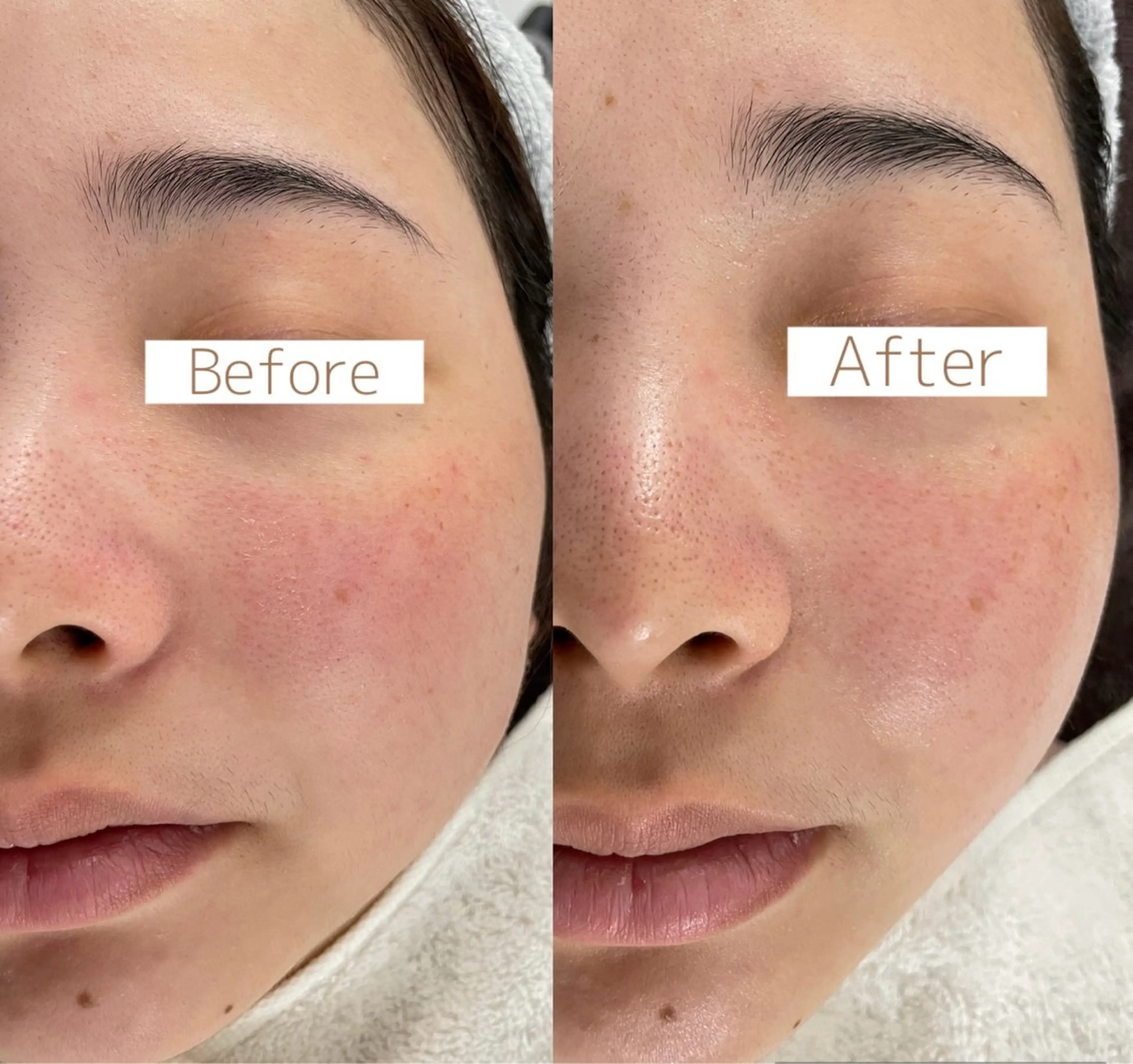 【速攻小顔】お肌の代謝upさせながらフェイスラインスッキリ！2台の機械を使ってお顔を引き上げます⭐︎の写真