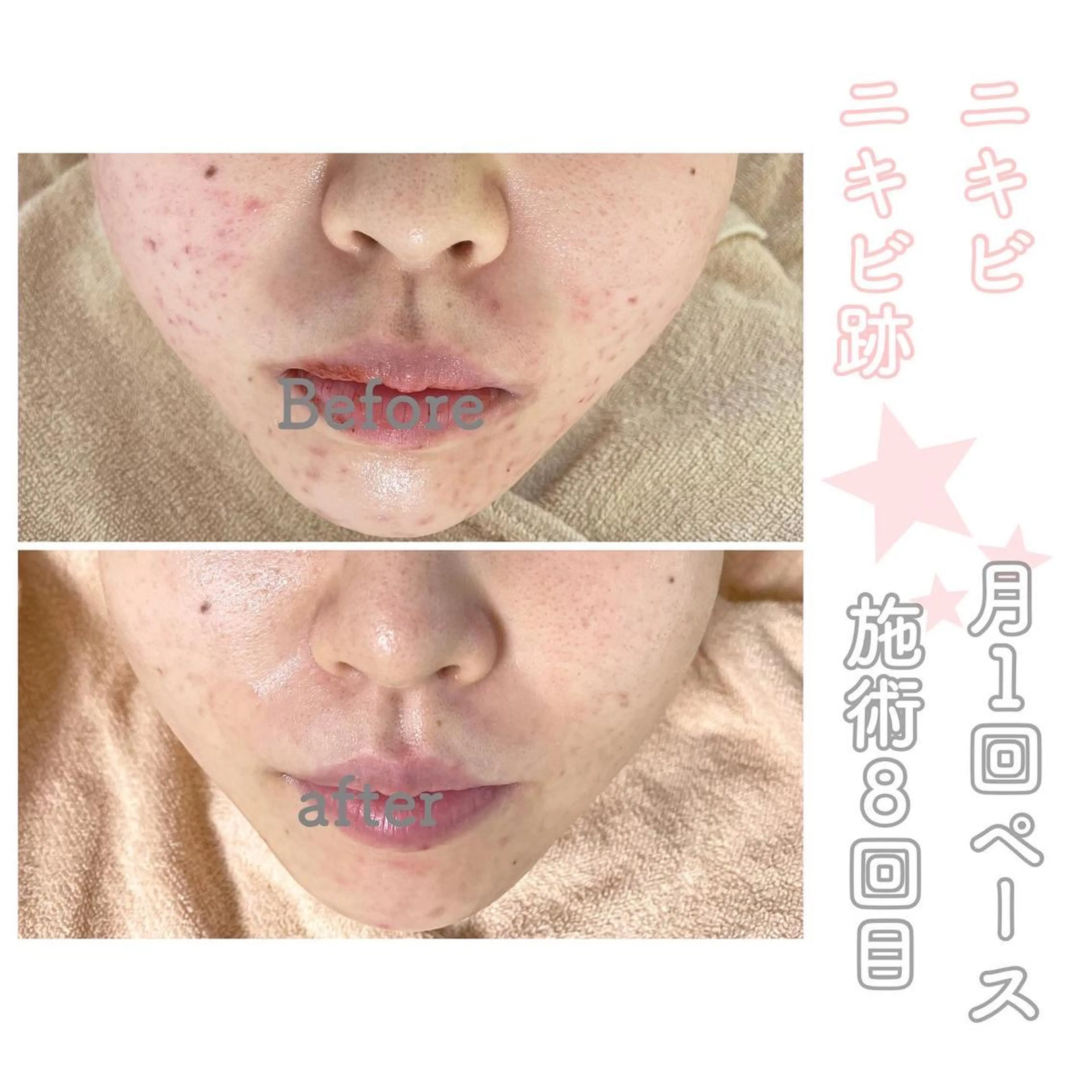 ミディアム カラー パーマ ヘアアレンジ メンズ キッズ ネイル マツエク・マツパ エステ ニキビ&跡改善サロン オーナー光木のエステ・リラクイメージ