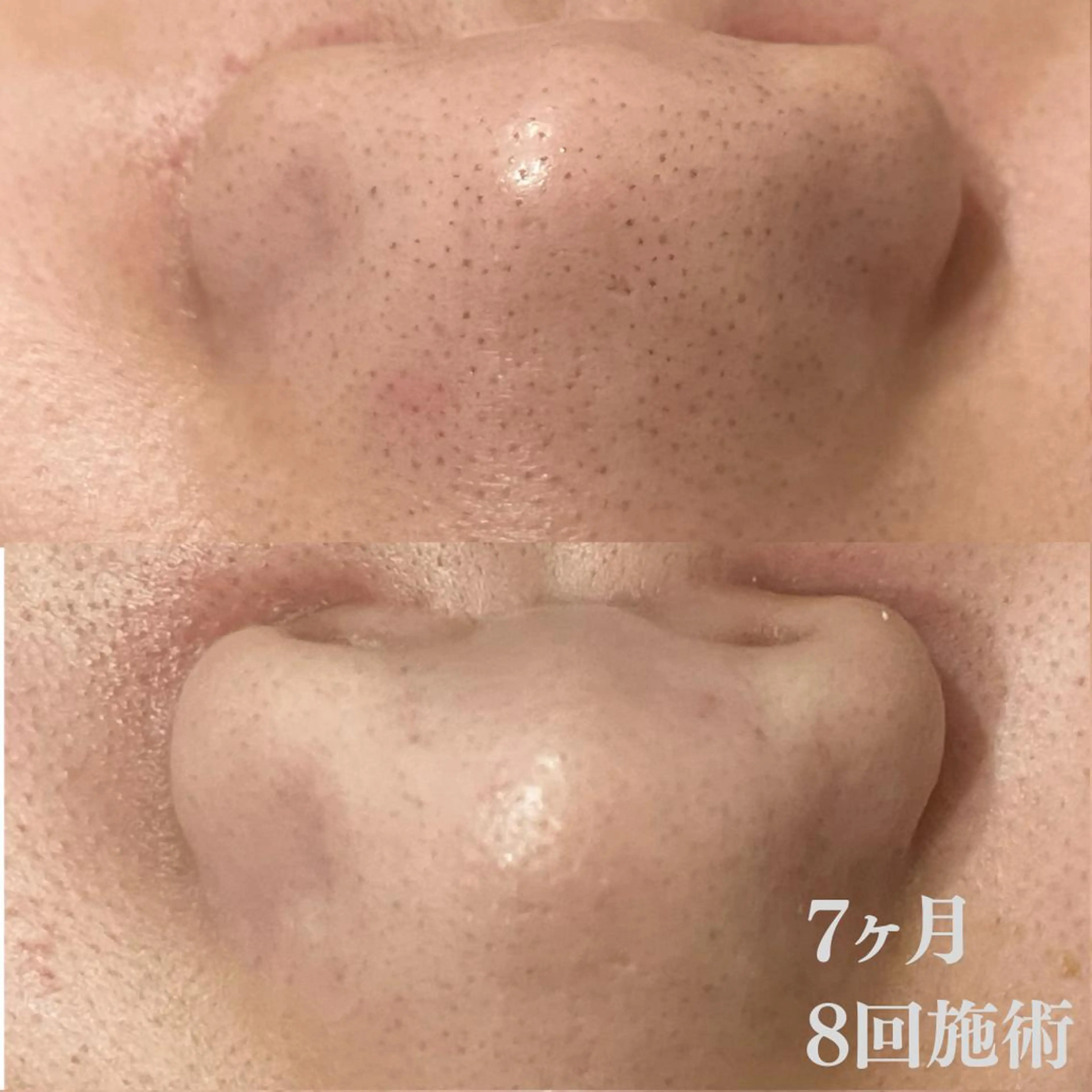 学生ニキビ改善🍀 優しい肌質改善のエステ・リラクイメージ