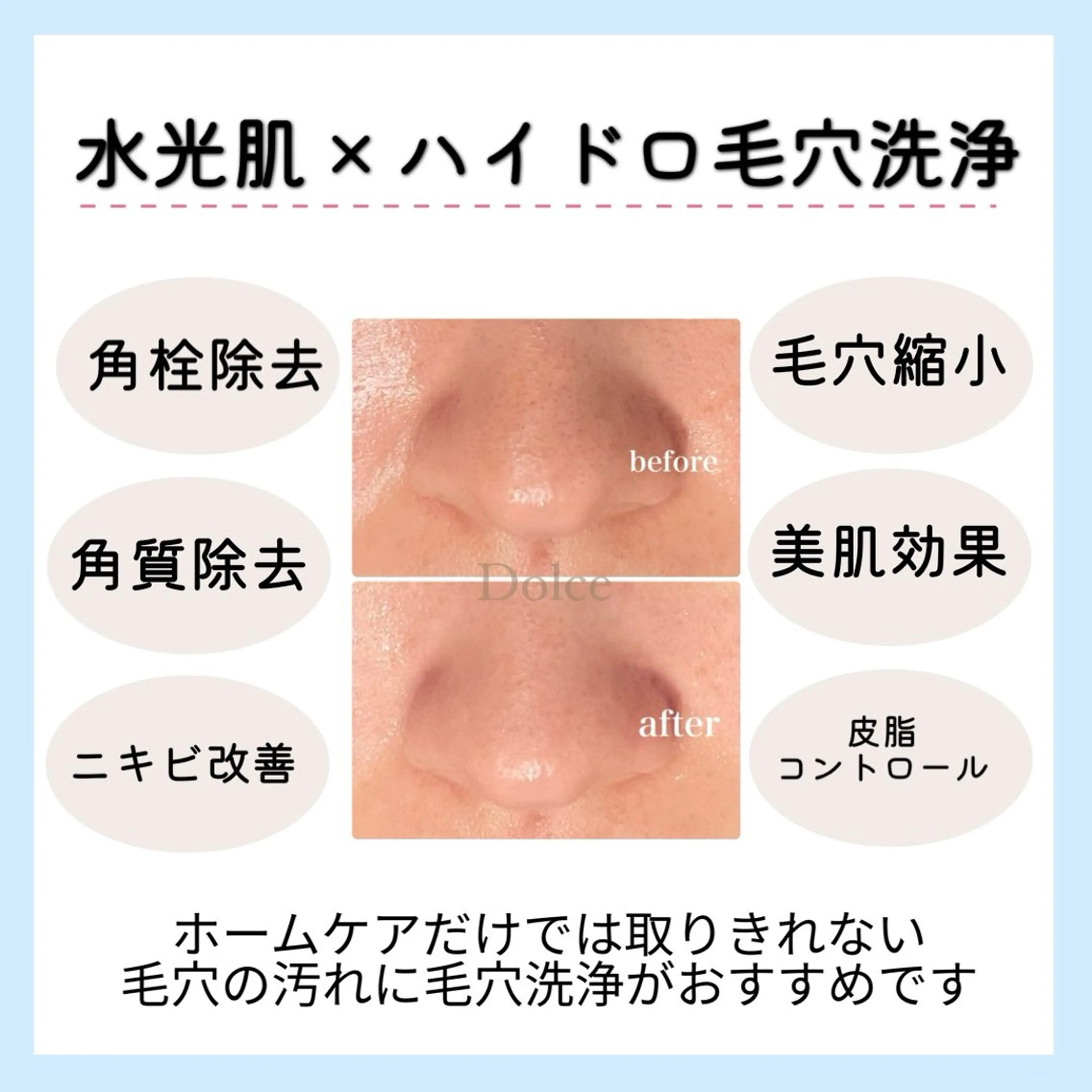 まずはお試し🦙⸝꙳【メンズもOK】水光肌ピーリング×ハイドロ毛穴洗浄の写真