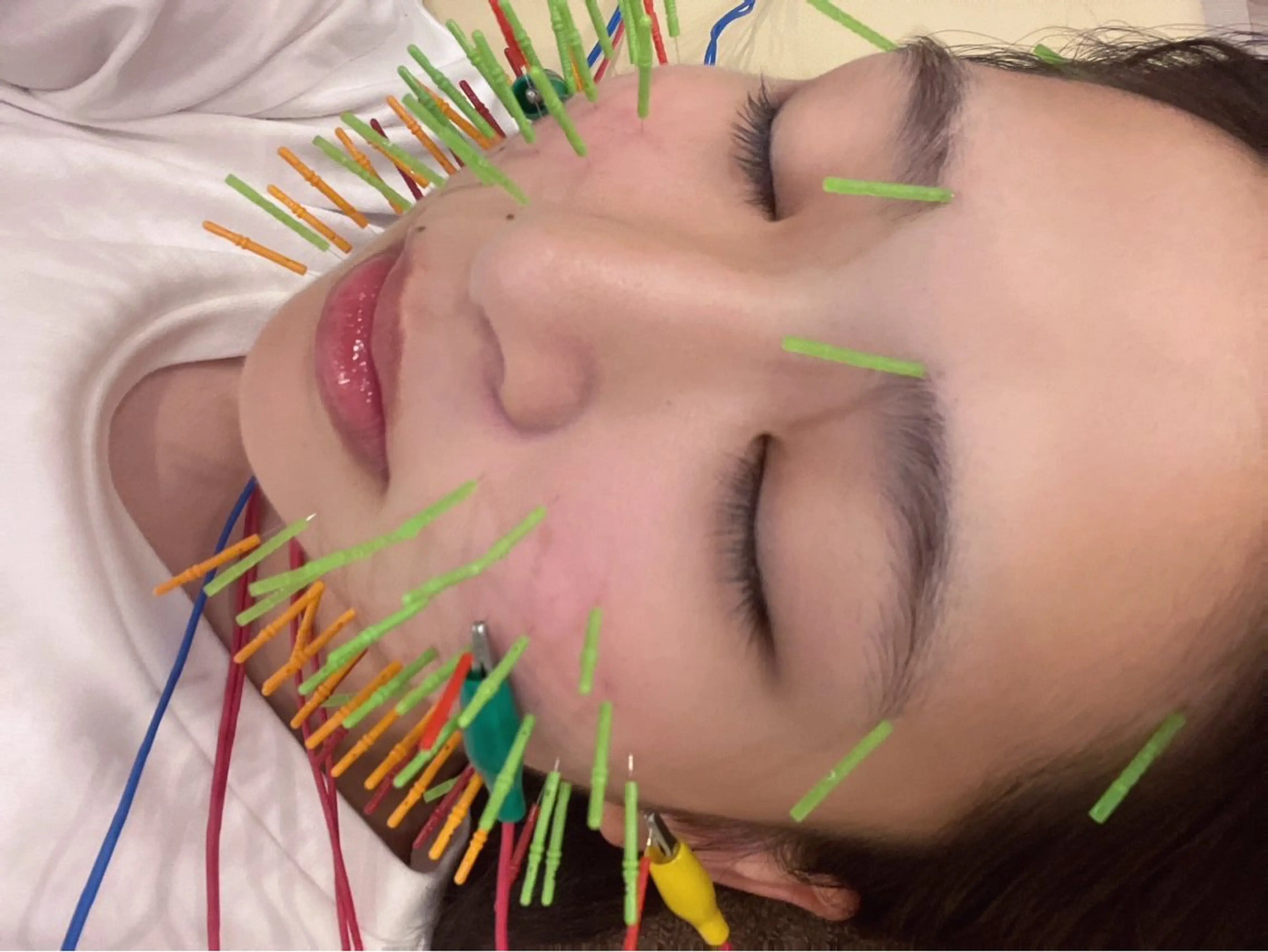 エステ リラク 美容鍼灸Solana所属・肌質改善×美容鍼 ゆいのエステ・リラクイメージ