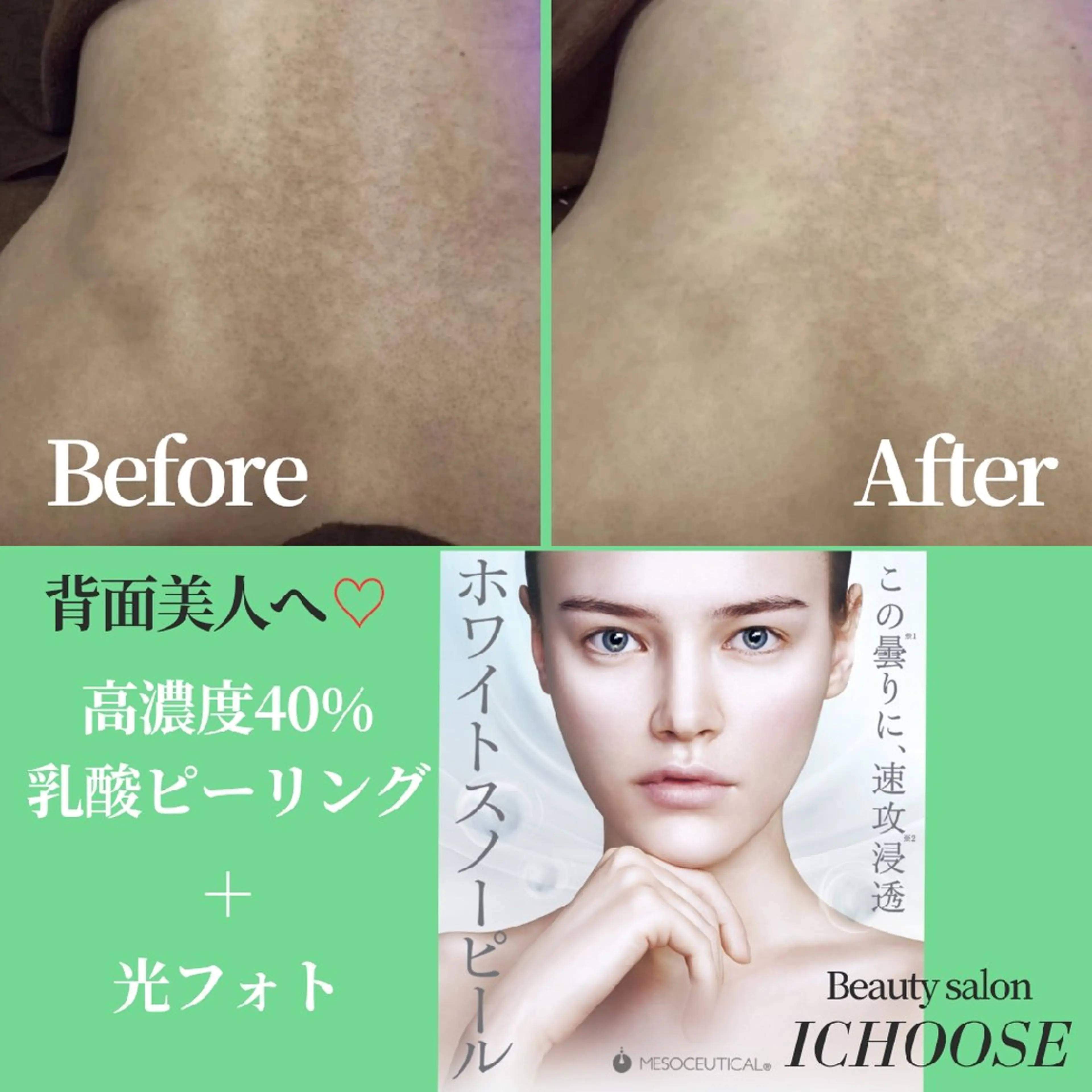 【🌹人に見せたくなる背中へ♡🌻】背中全体スペシャル〈光フォト＋乳酸ピーリング＋海藻パック〉の写真