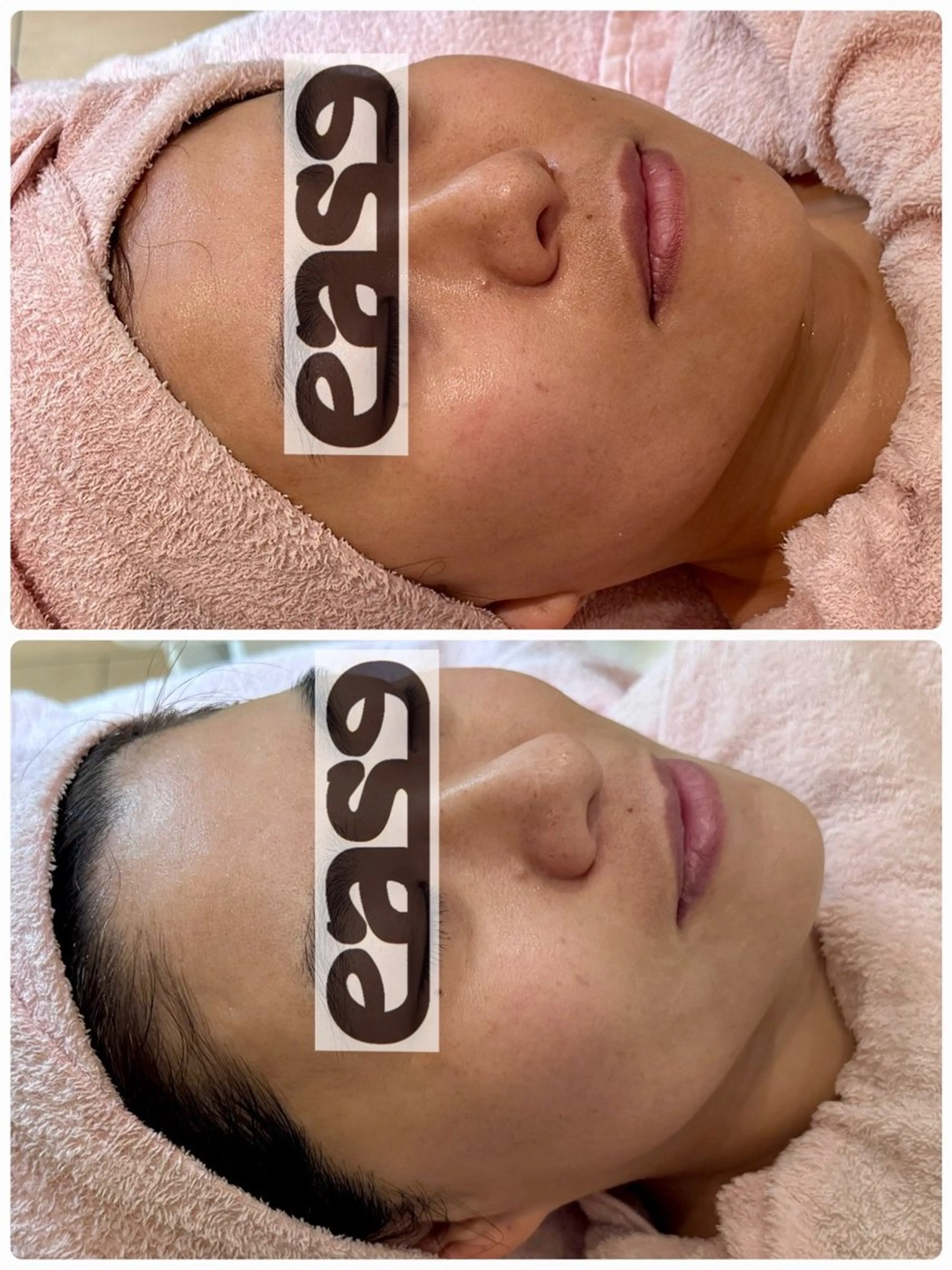 【瞬間小顔リフトアップコース💆‍♀️】表情筋トレーニングで引き上げ❣️目元口元フェイスラインすっきりの写真