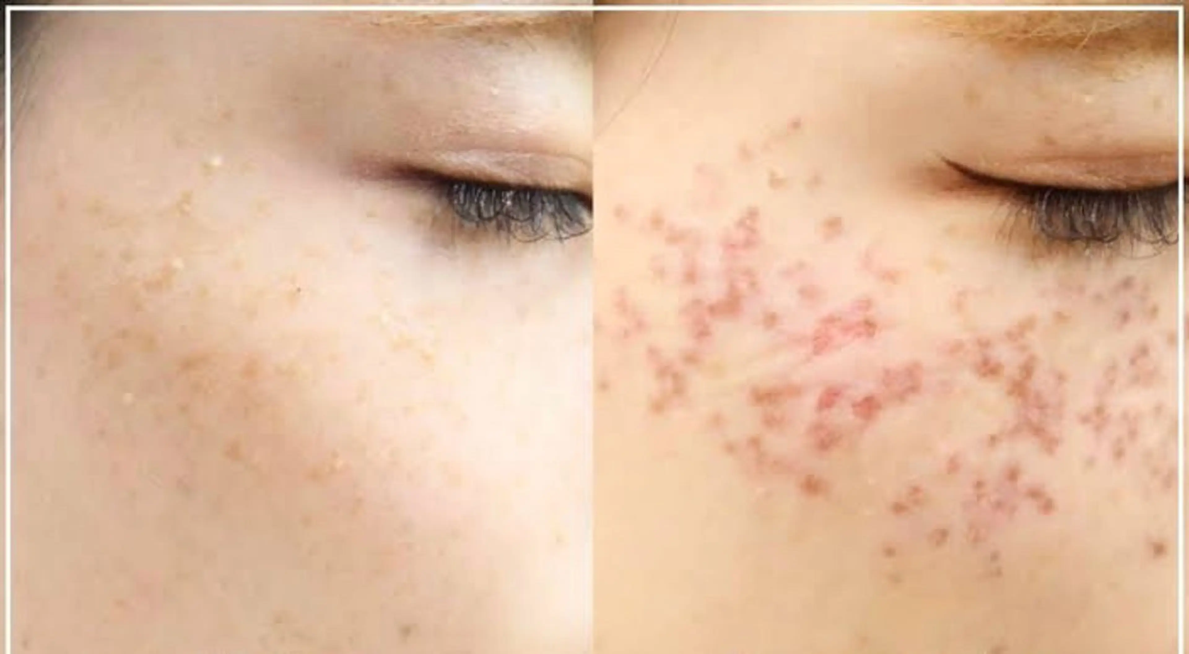 シミ、ホクロ、イボ、取り放題！！気になるしみ、ほくろ、いぼがかさぶたになってポロっと取れる😍の写真