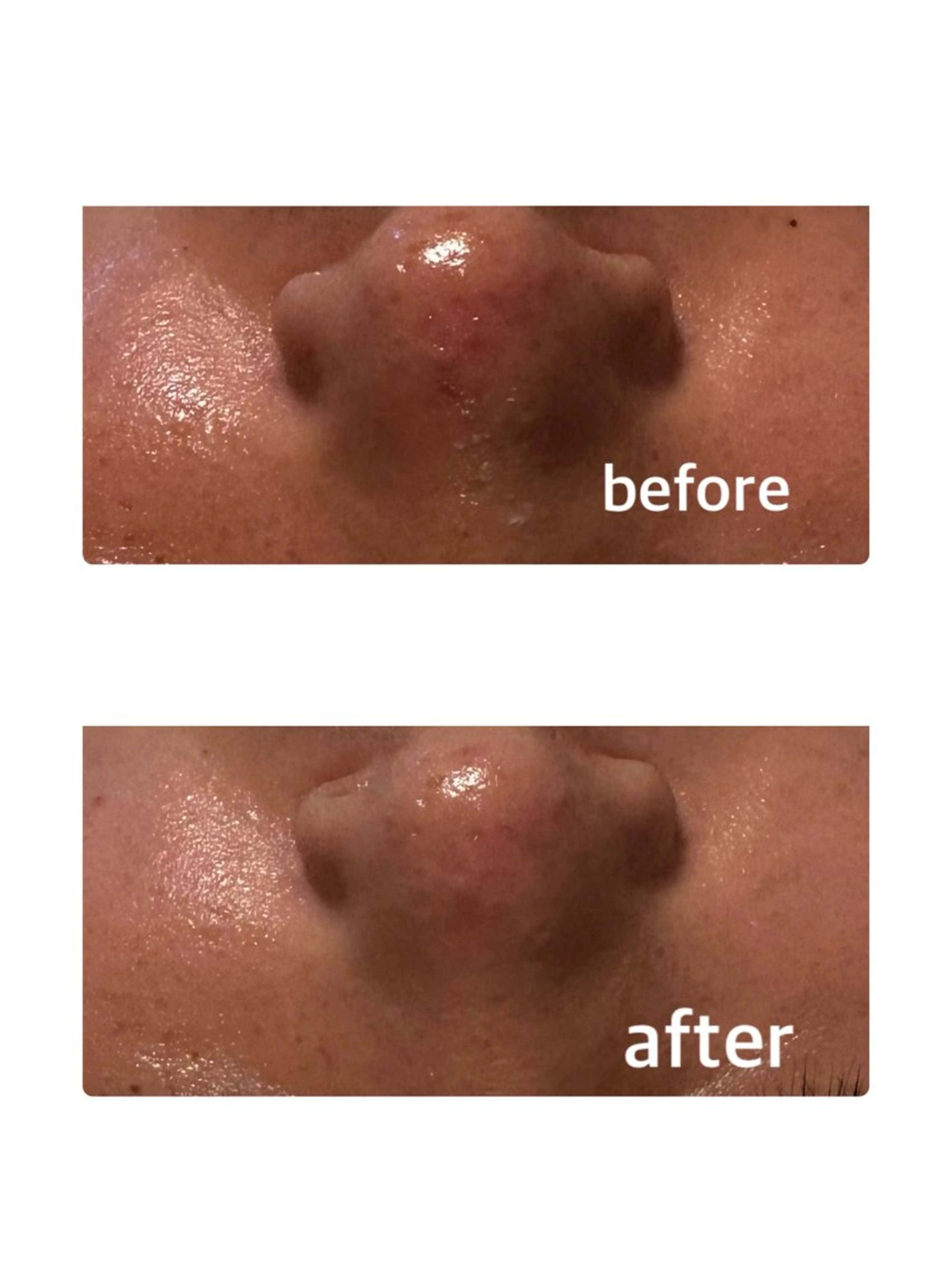 毛穴スッキリ透明感アップ⤴️コースの写真