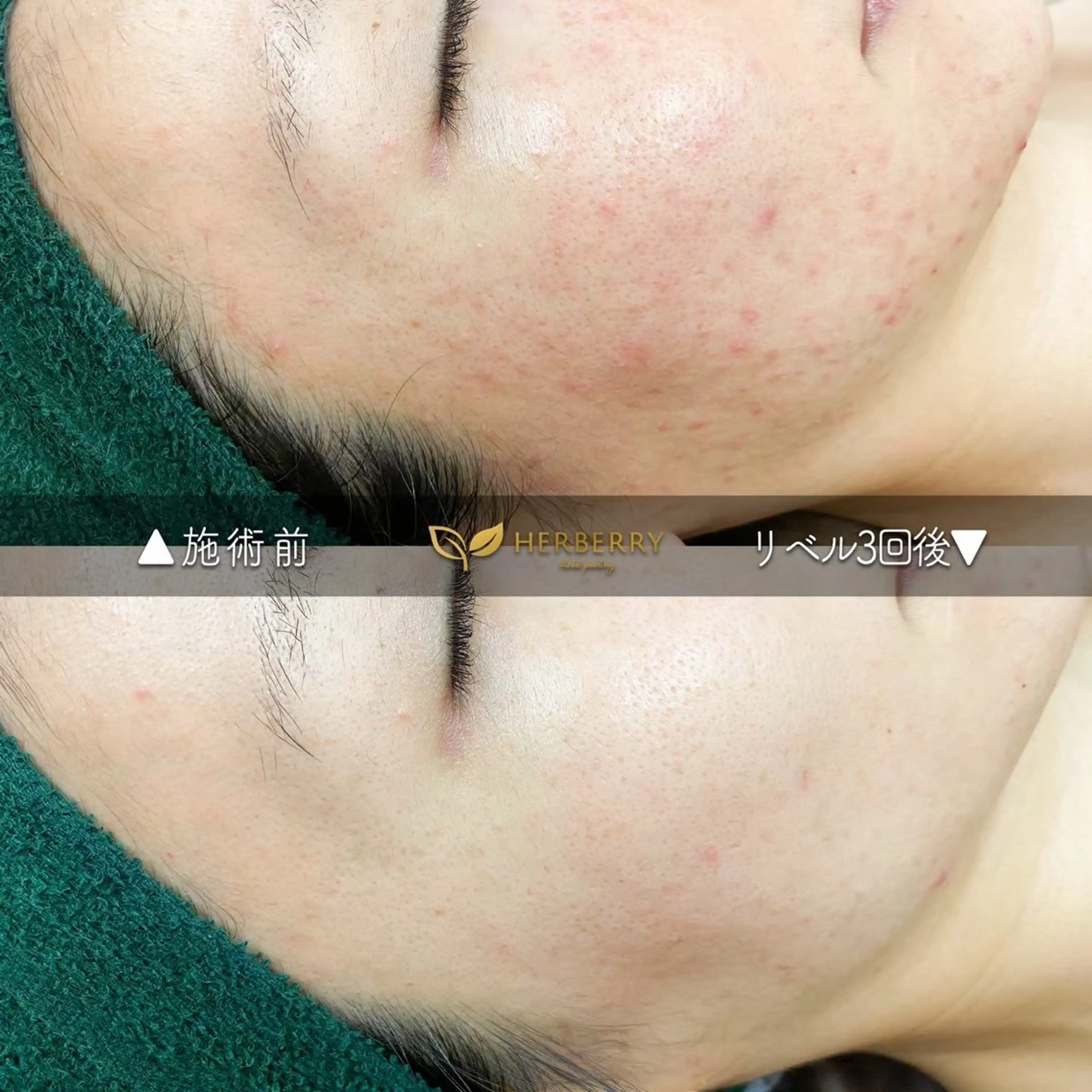 BLANC.【新宿店】所属・ハーブピーリング ayamiのエステ・リラクイメージ