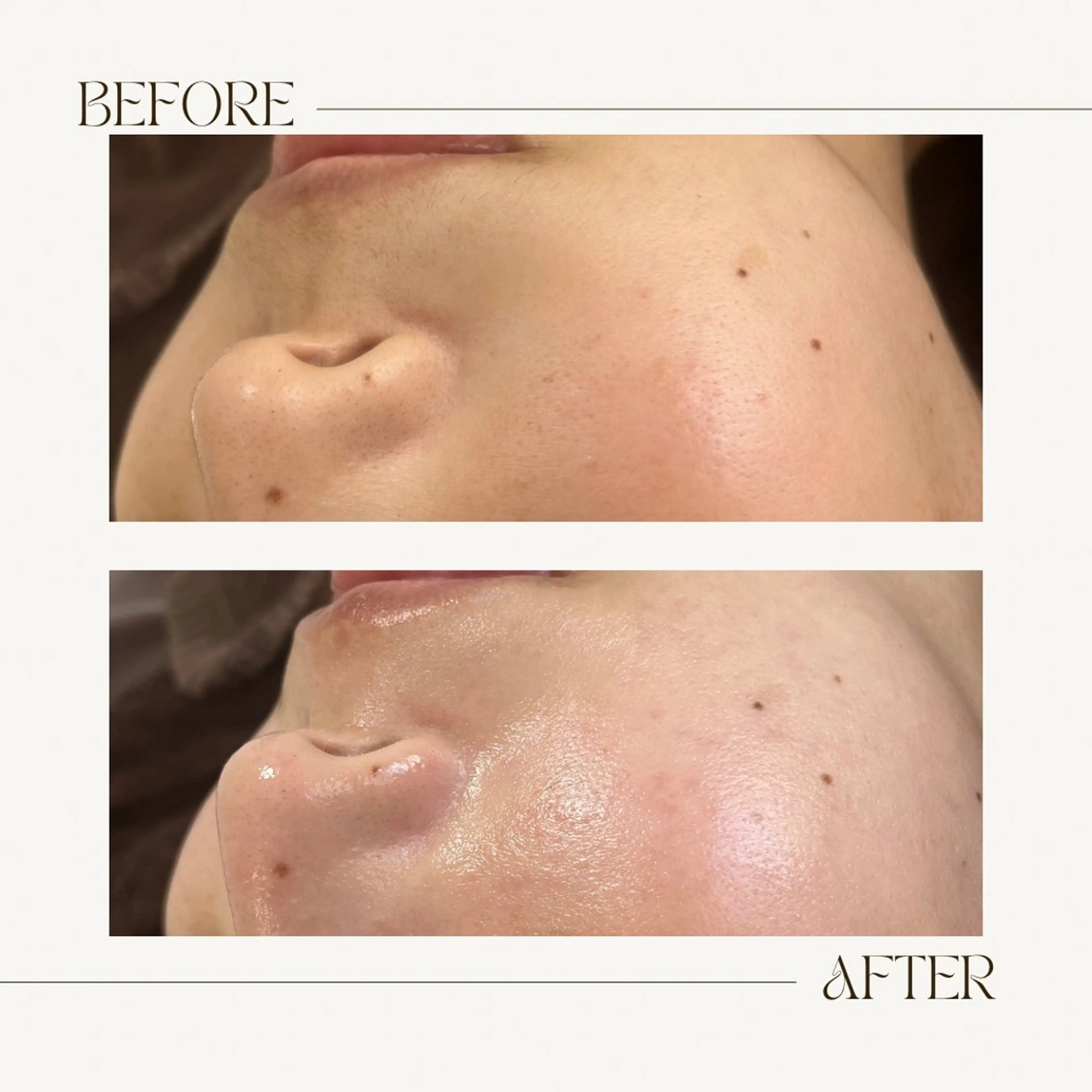 脱毛 1st｜フェイシャル エステ専門店のエステ・リラクイメージ