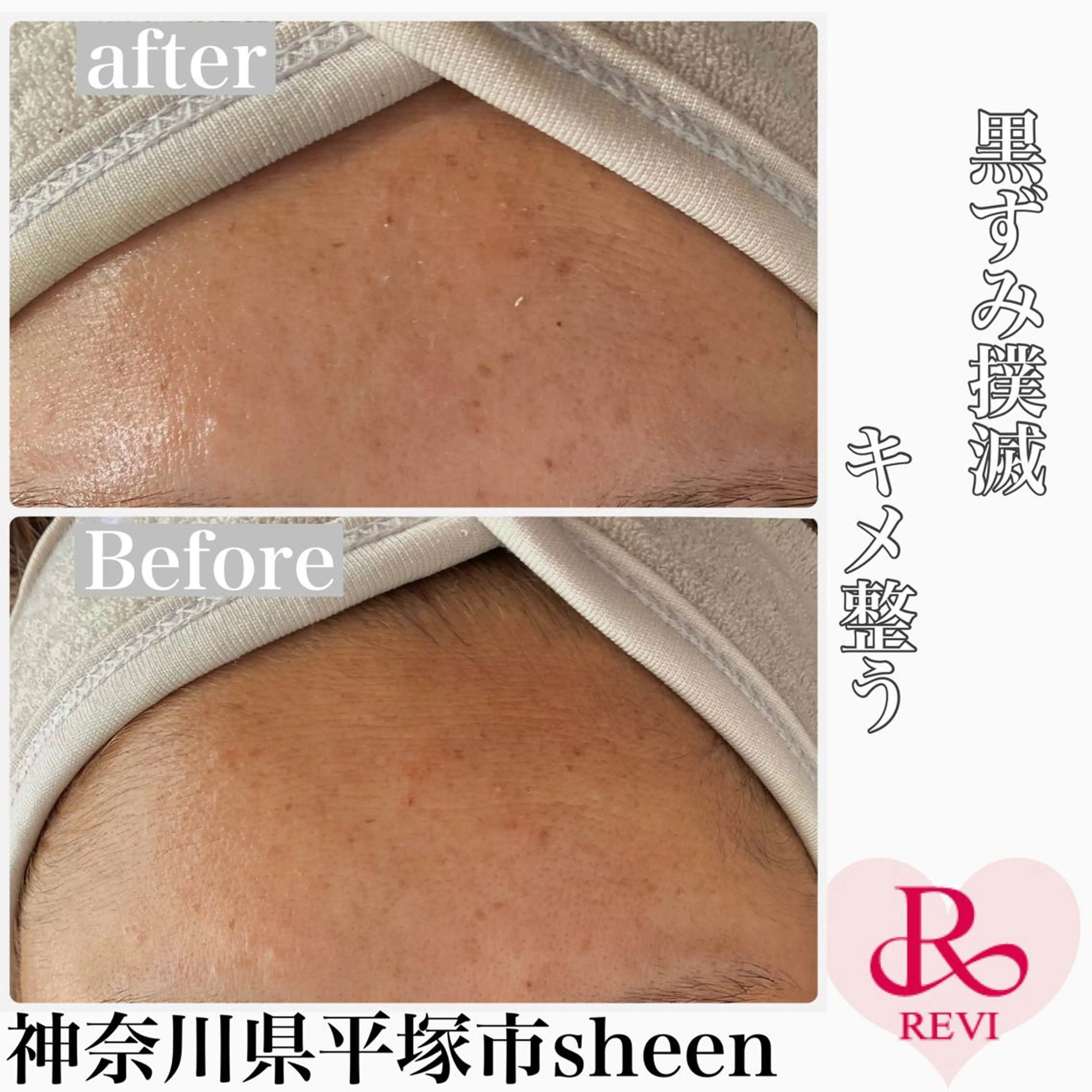 エステ Chalon所属・REVI取扱・肌悩み 毛穴Chalonのエステ・リラクイメージ