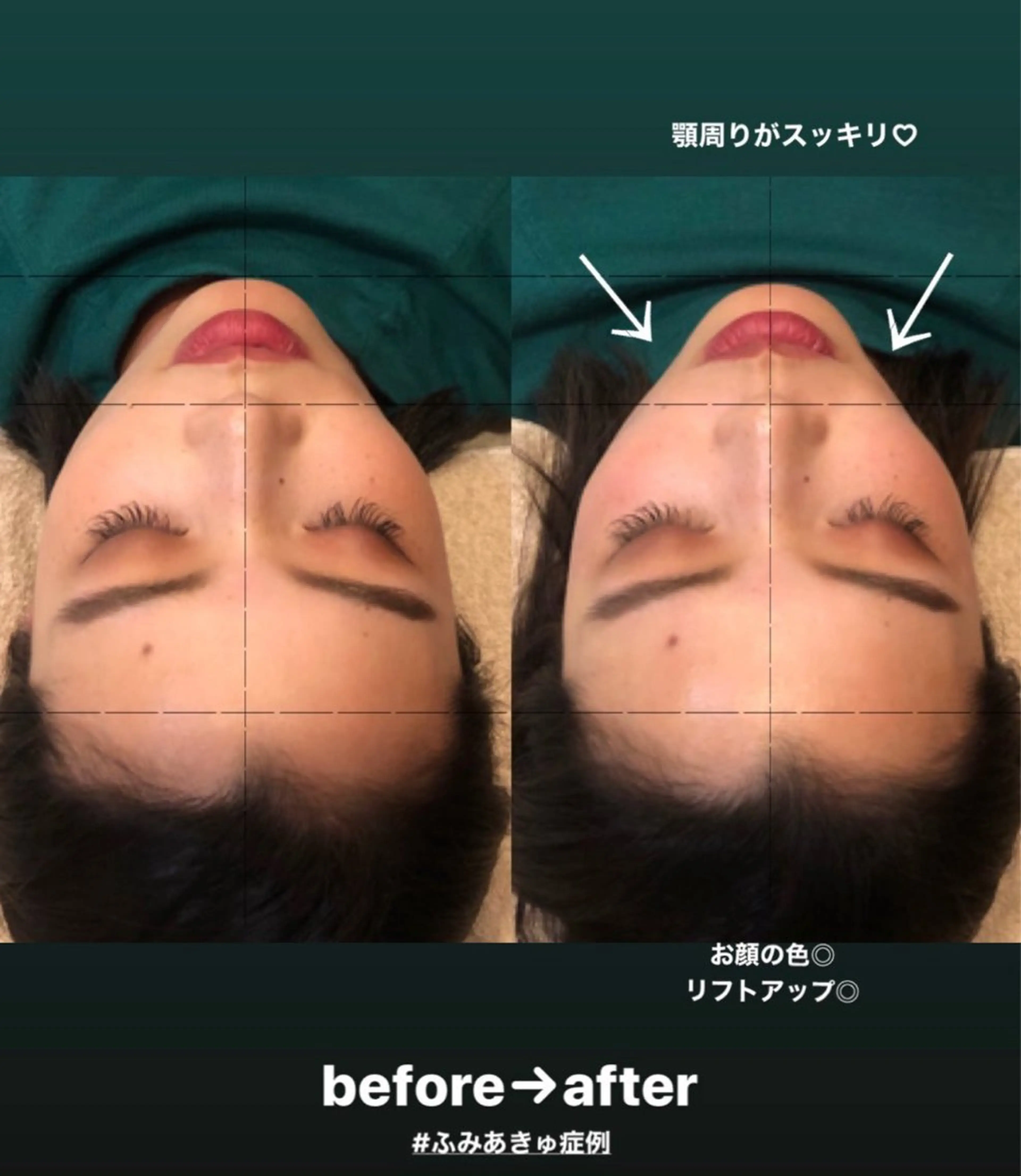 THE  ROOTS所属・美容鍼♡小顔矯正♡ fumikaのエステ・リラクイメージ