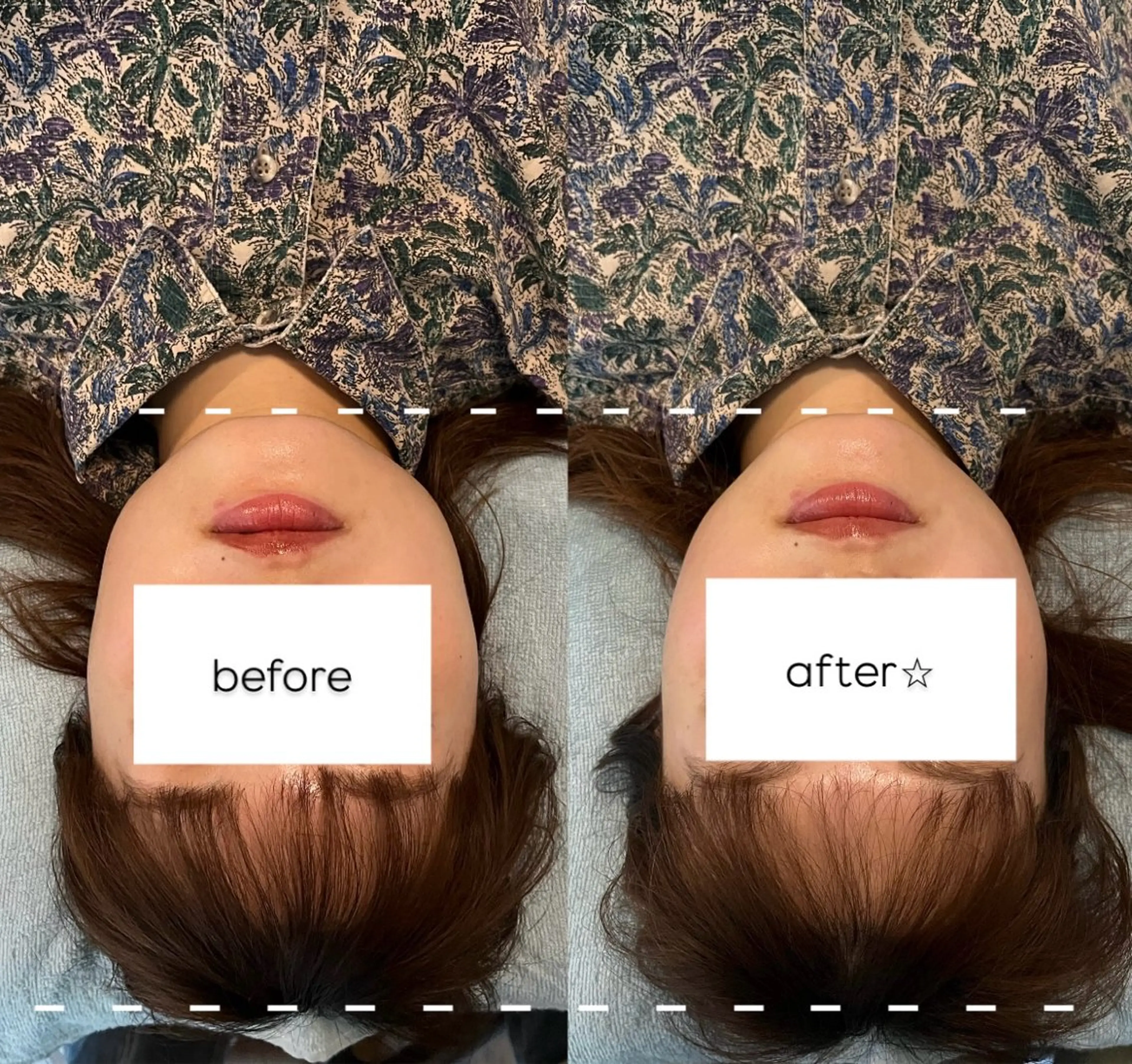 美容鍼 (顔，頭) 🦔🌿🪡の写真