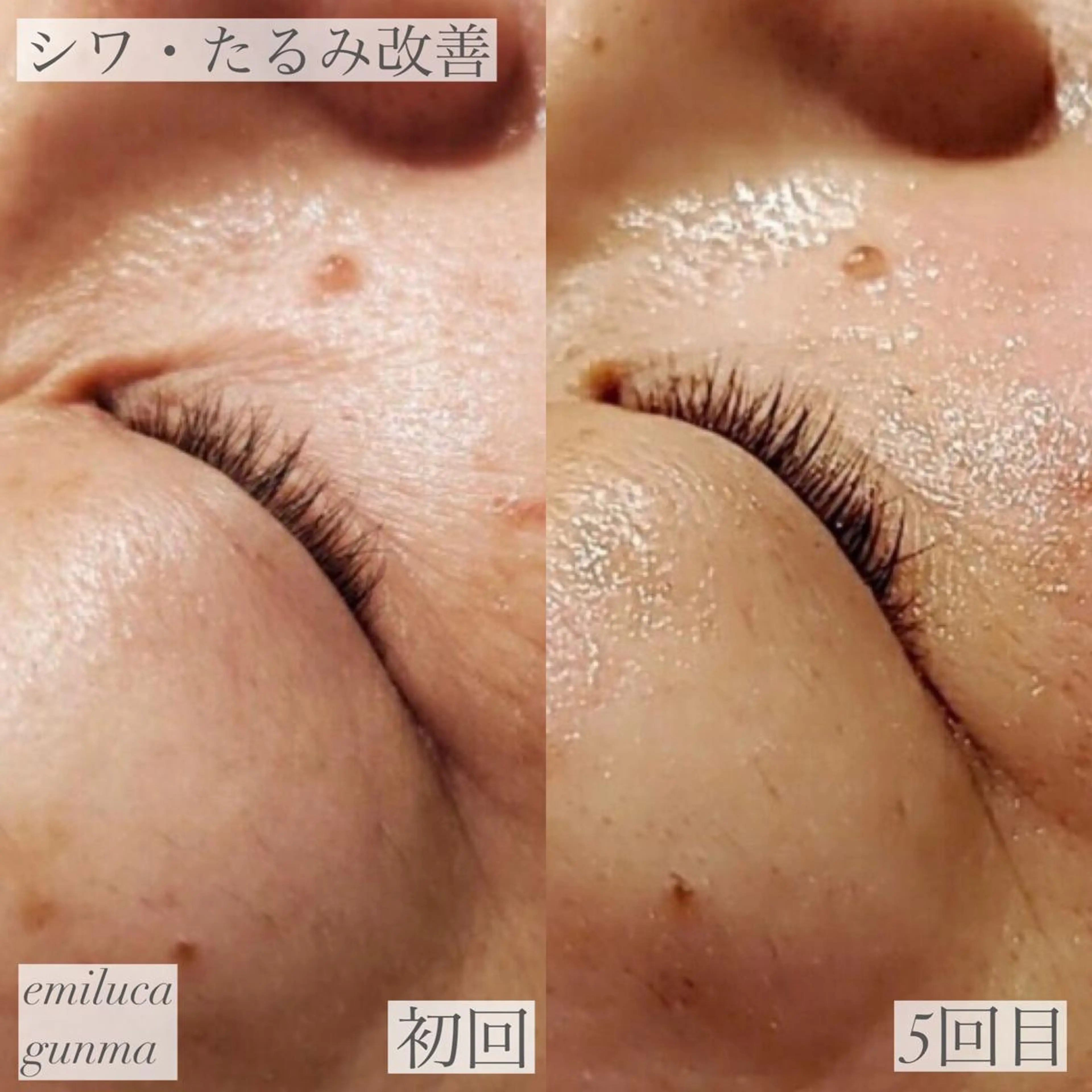 emiluca西目/ 毛穴洗浄/細胞美容のエステ・リラクイメージ