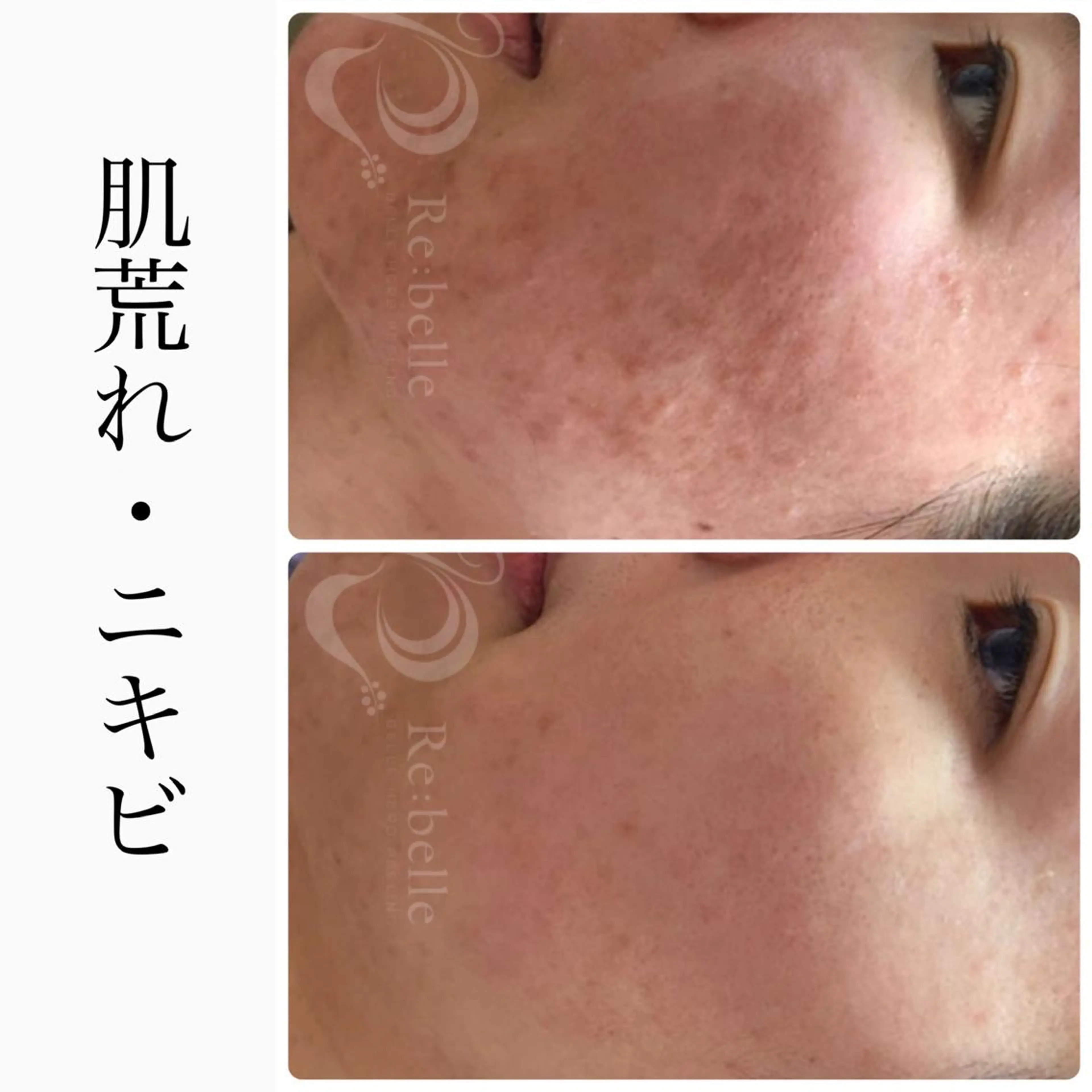 エステ BeSkin藤沢店所属・ニキビ/肌質改善 BeSkin 藤沢店のエステ・リラクイメージ