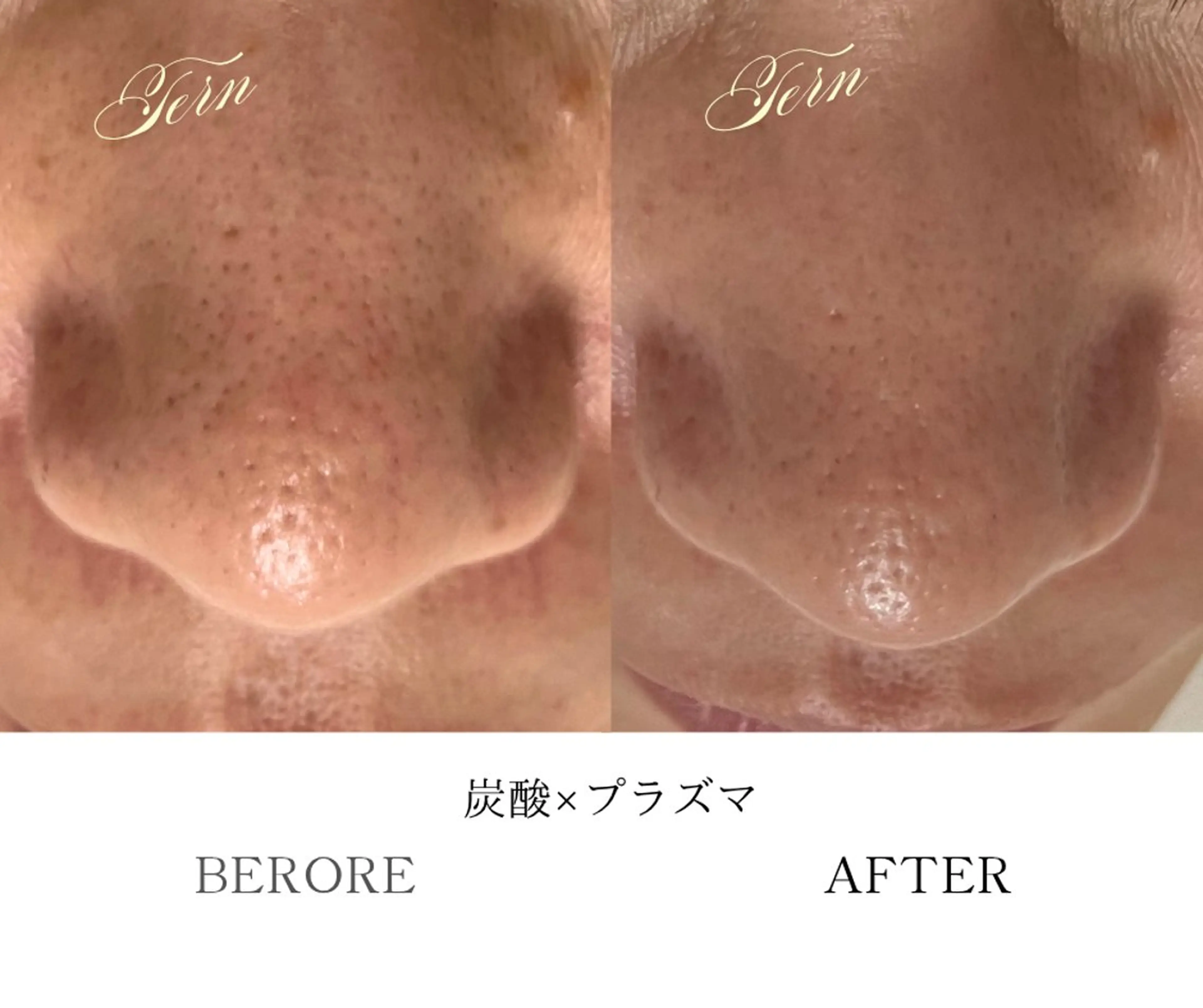 【特許取得施術】思わず触りたくなる肌へ！繰り返すニキビ・肌荒れ改善⭐︎プラズマ毛穴ケアの写真