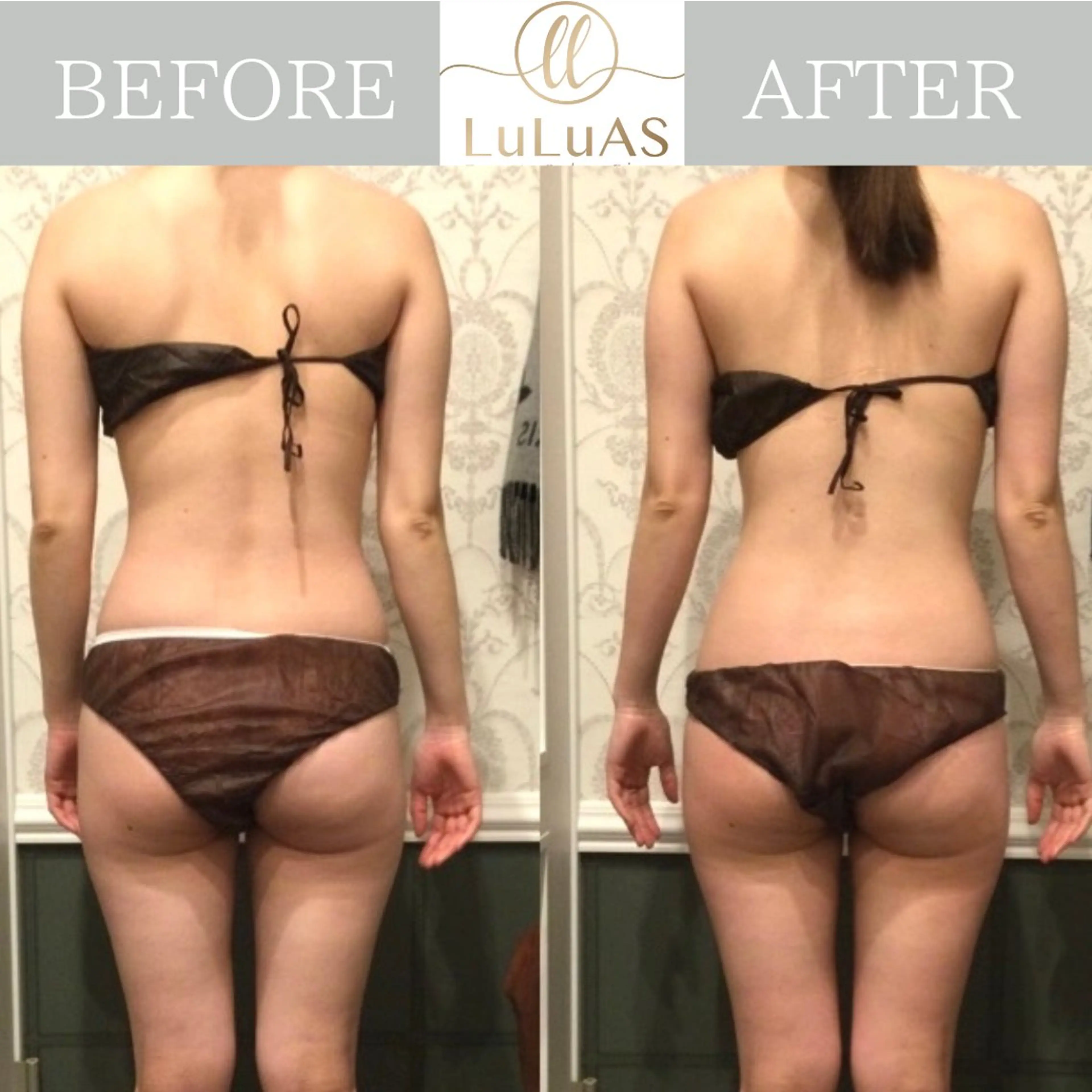 【結果重視‼️痩身90分×6回コース】痩せたいけど痩せられない方必見‼️3ヶ月でボディメイク🙌🏻の写真