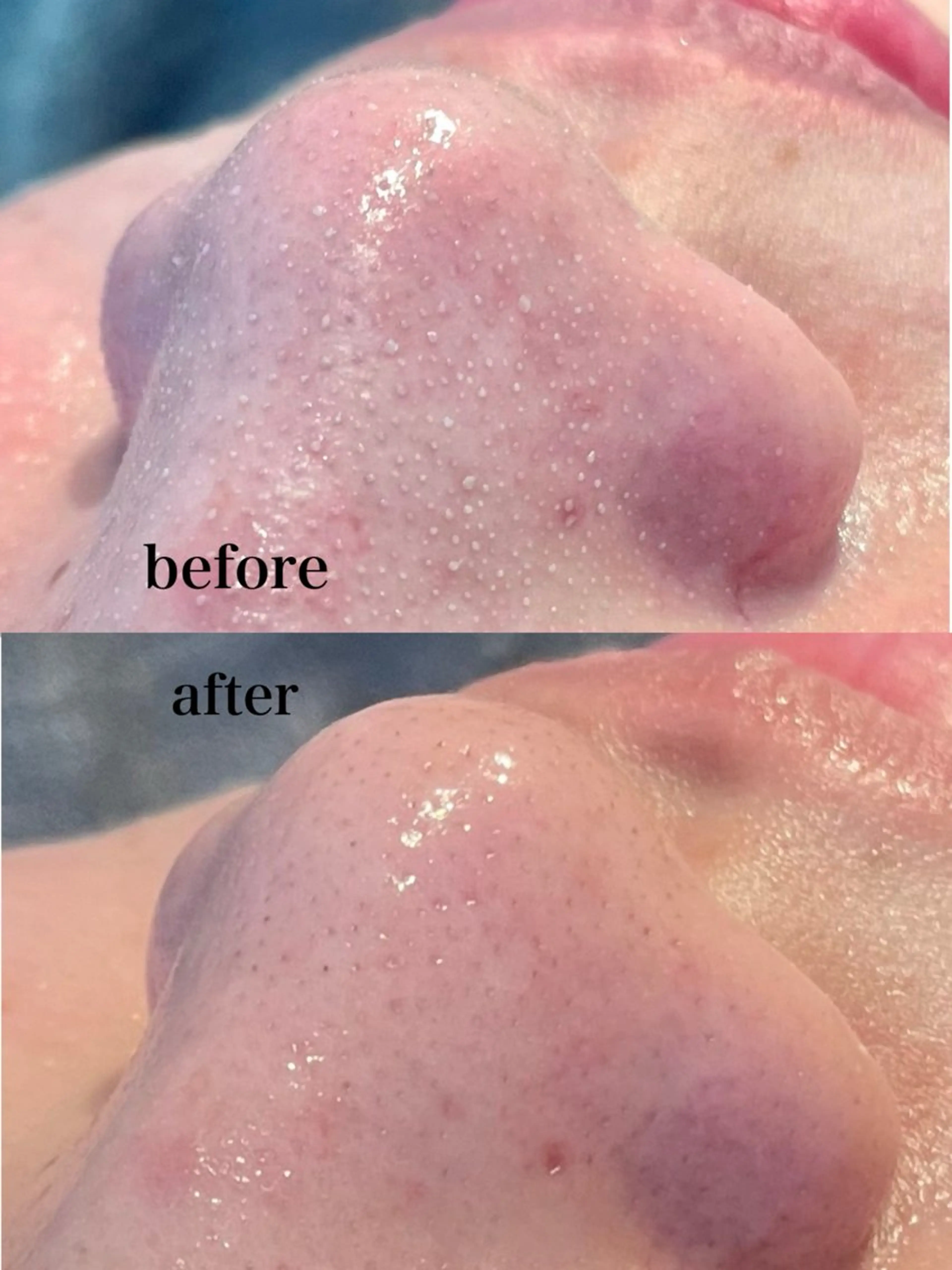 ✨毛穴洗浄✨毛穴詰まり/いちご鼻/くすみ/ざらつきの写真