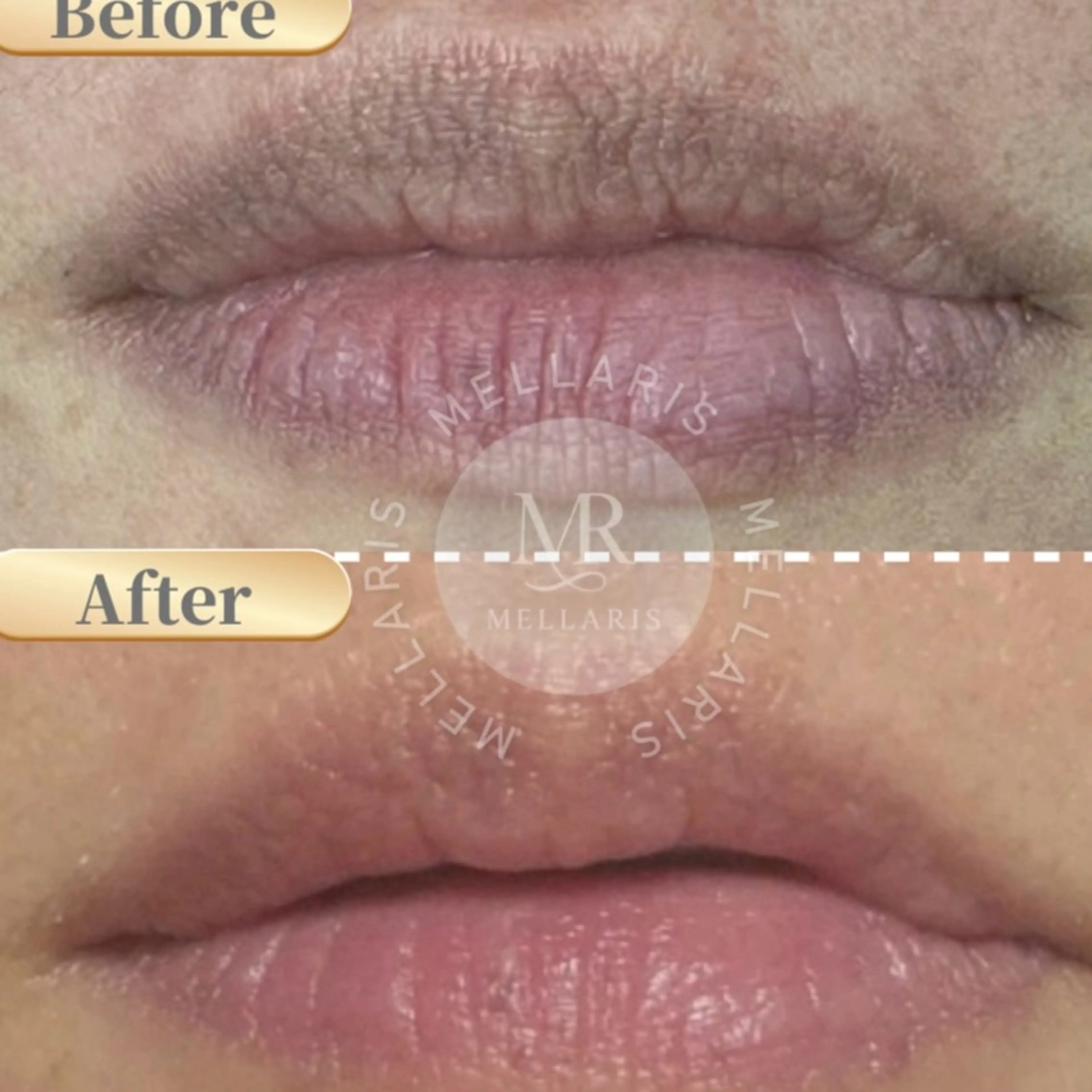 【1/17​〜​】リップ黒ずみ除去💋アフターケアクリーム付！国産メラニンケア✨唇をピンクに！ルメラ・ローマピンクの次世代版の写真