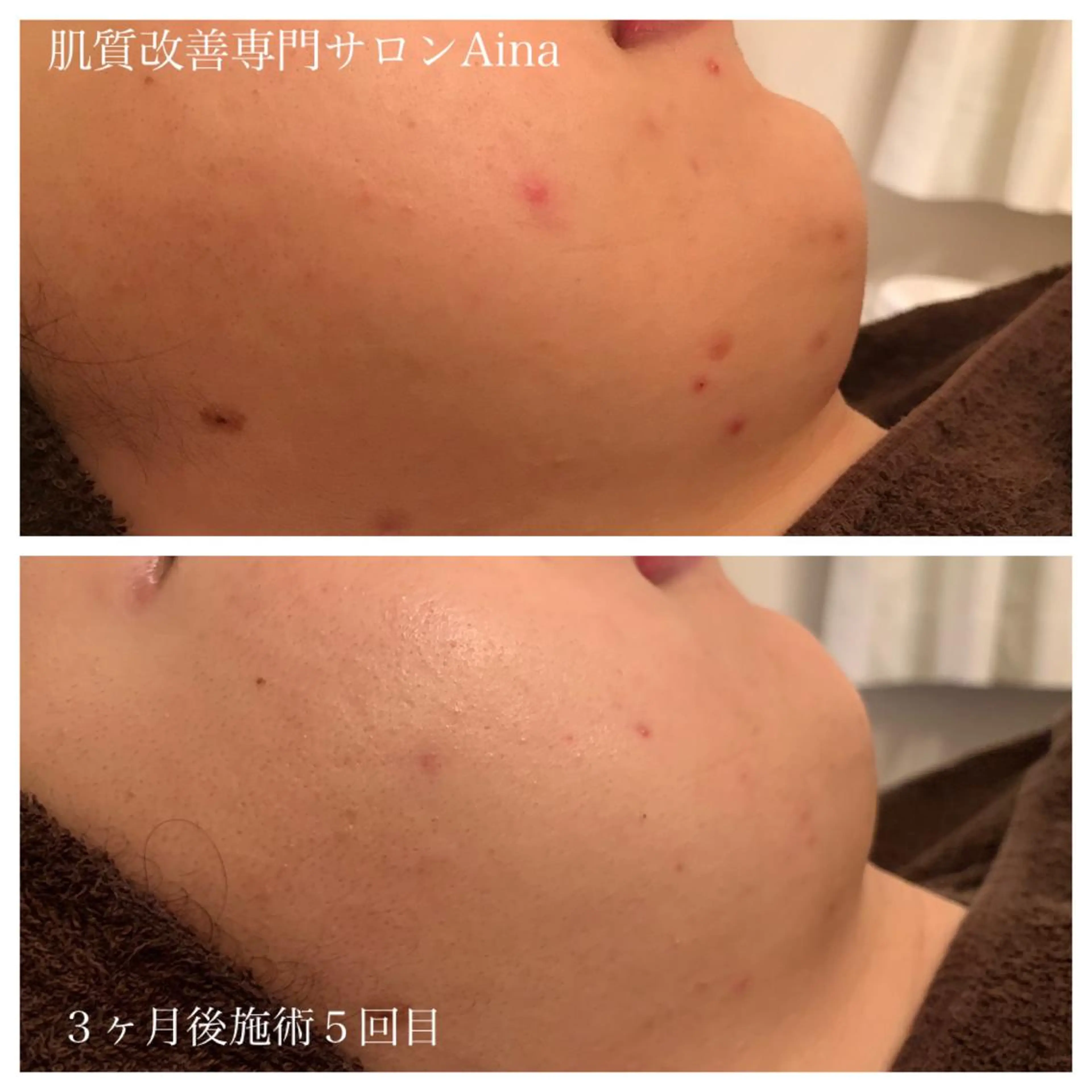 ミディアム パーマ キッズ ネイル マツエク・マツパ エステ リラク ニキビ跡専門サロン Ａｉｎａのエステ・リラクイメージ