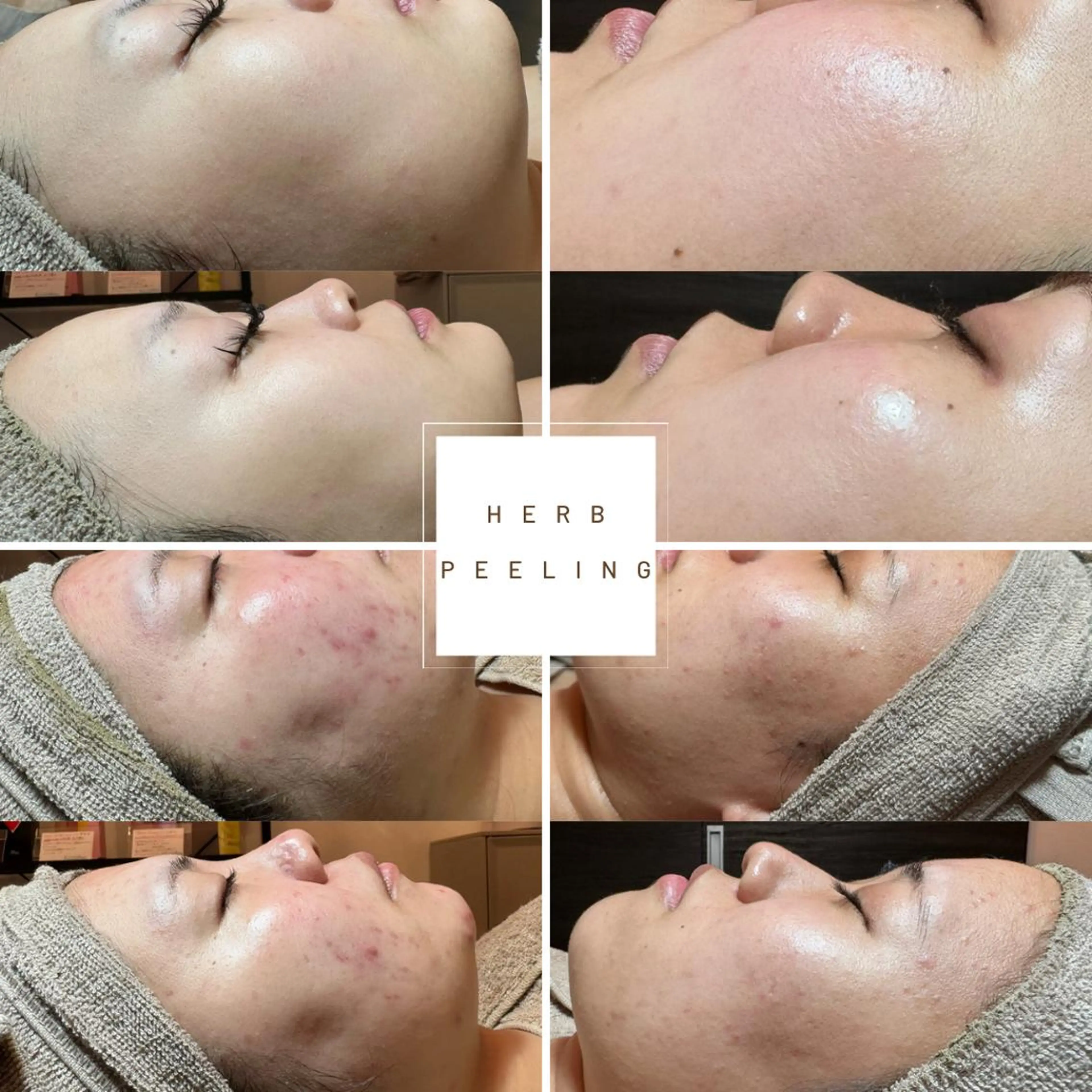 【お試し！口コミ！】REVIハーブピーリング（剥離なし）ご新規様限定🌿¥5500の写真