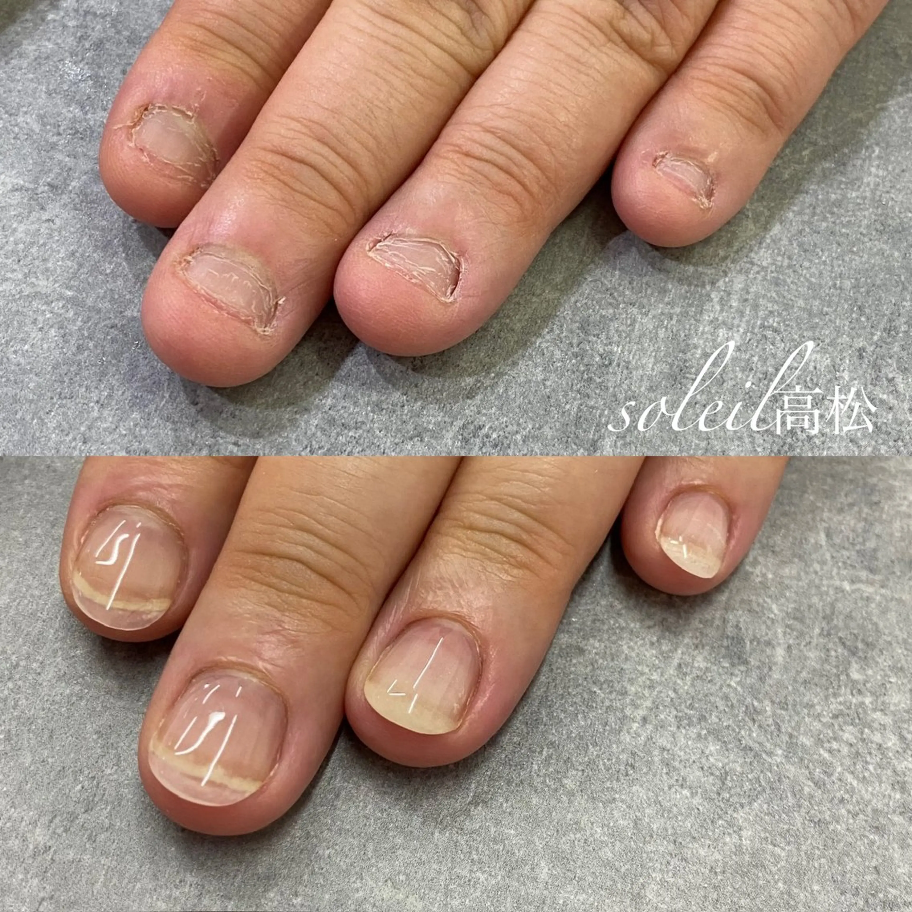 深爪矯正リペア※三週間以内の写真