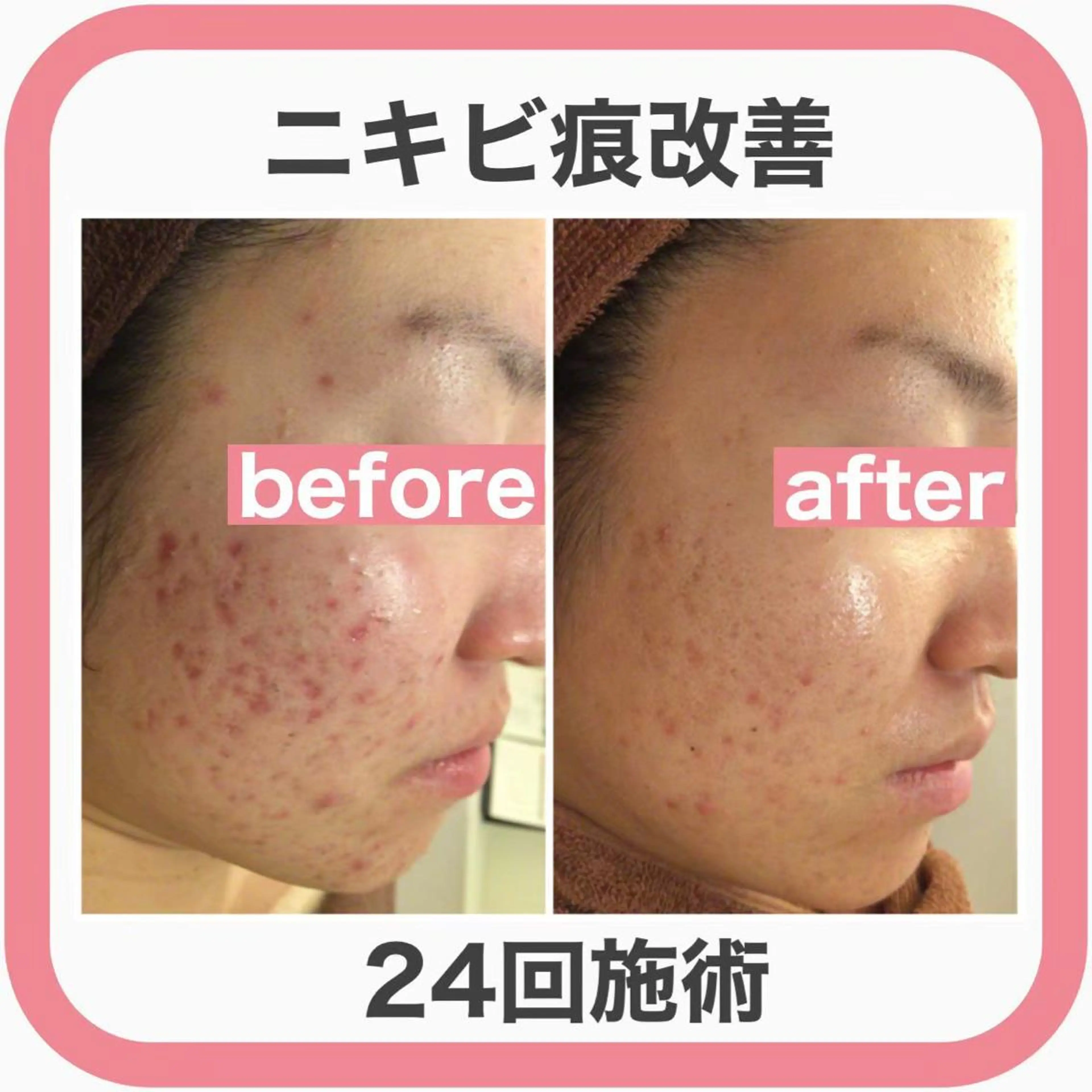 ニキビ跡改善専門🔥 医療にはできない改善のエステ・リラクイメージ
