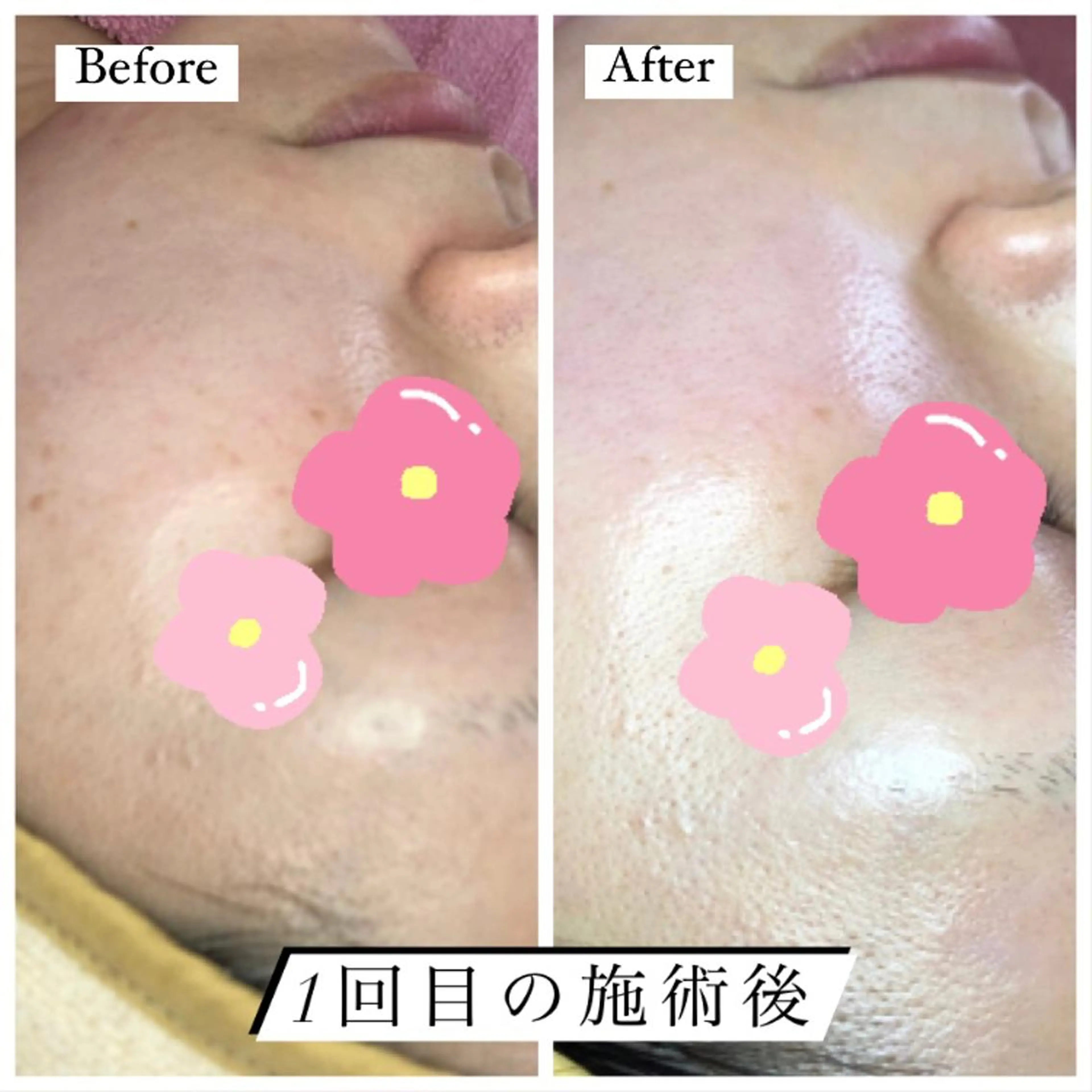 エステ ニキビ/敏感肌/乾燥 Lilyauraのエステ・リラクイメージ