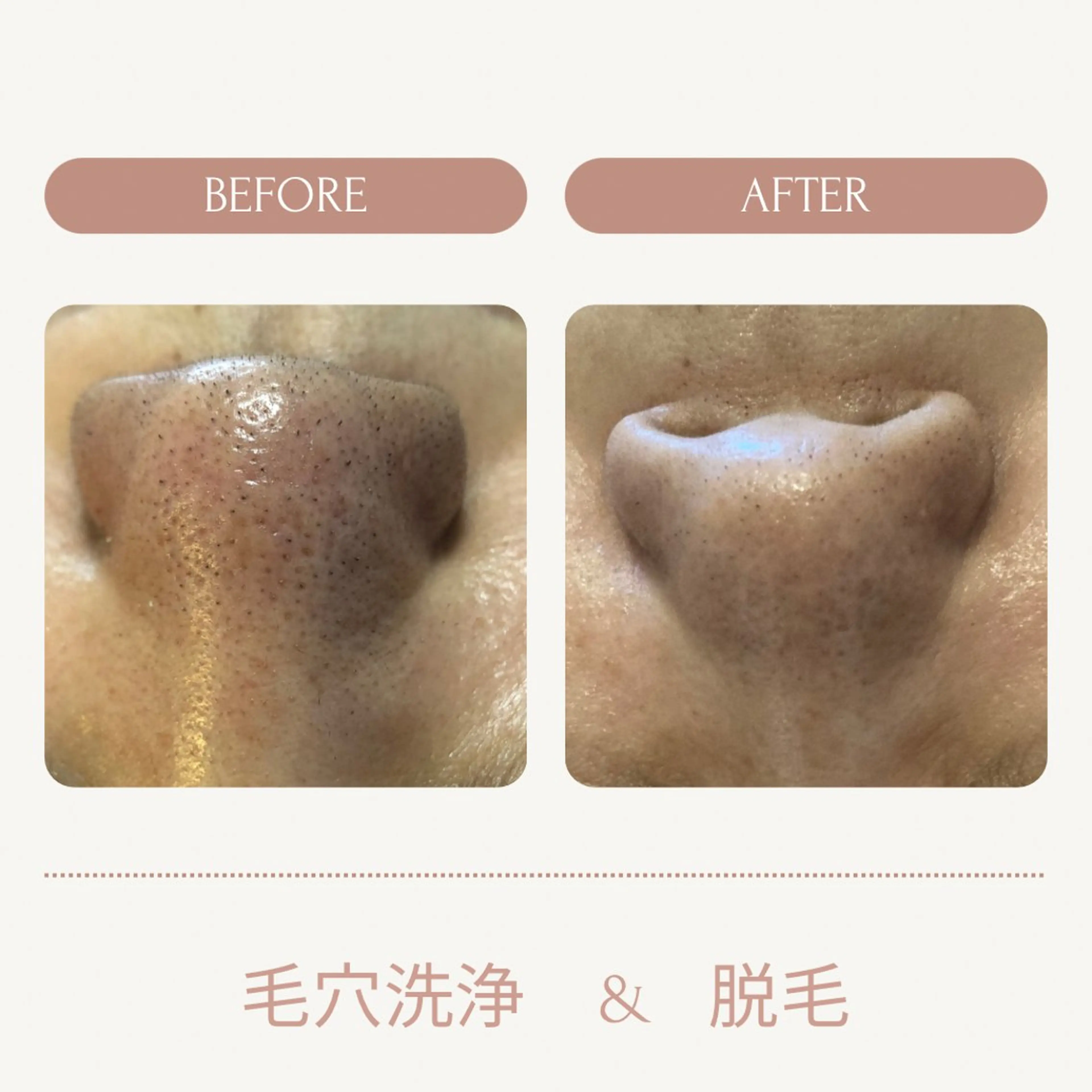 【毛穴洗浄ハイドロ＆顔脱毛】《火曜　水曜　土曜限定》美容液で贅沢毛穴クレンジング✨お顔脱毛とセットで丸ごとツルツル💖の写真